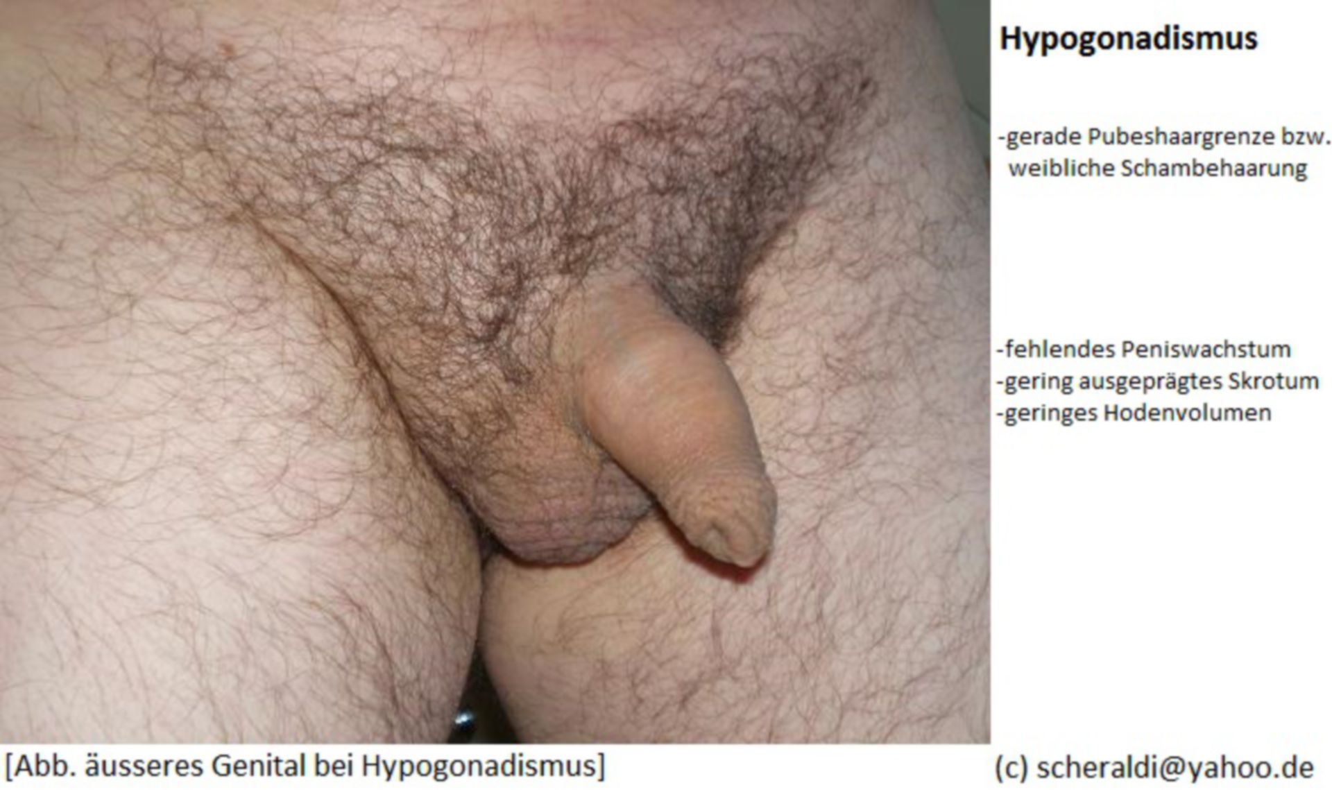 Hypogonadismus