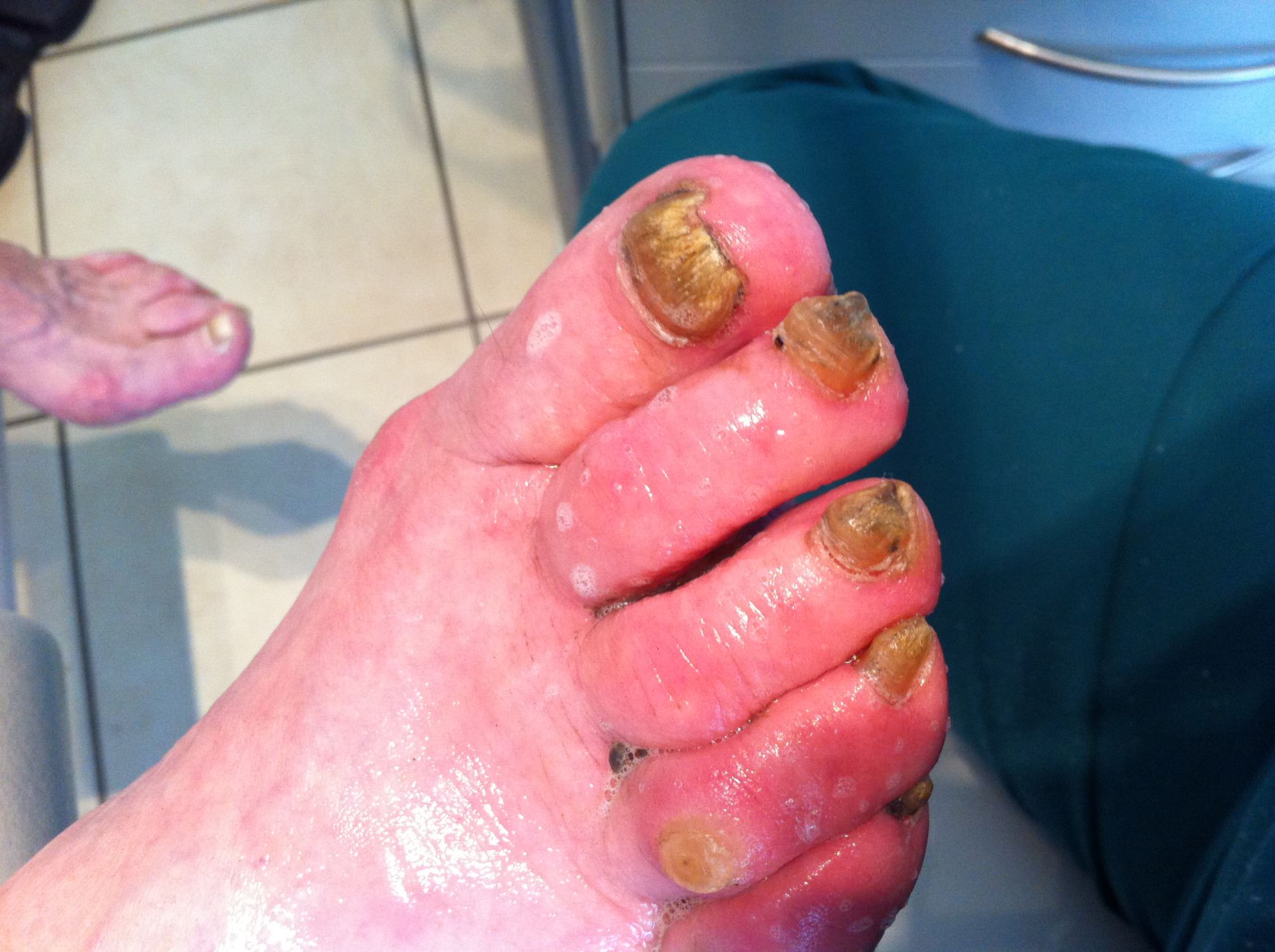 Long time no podiatry care