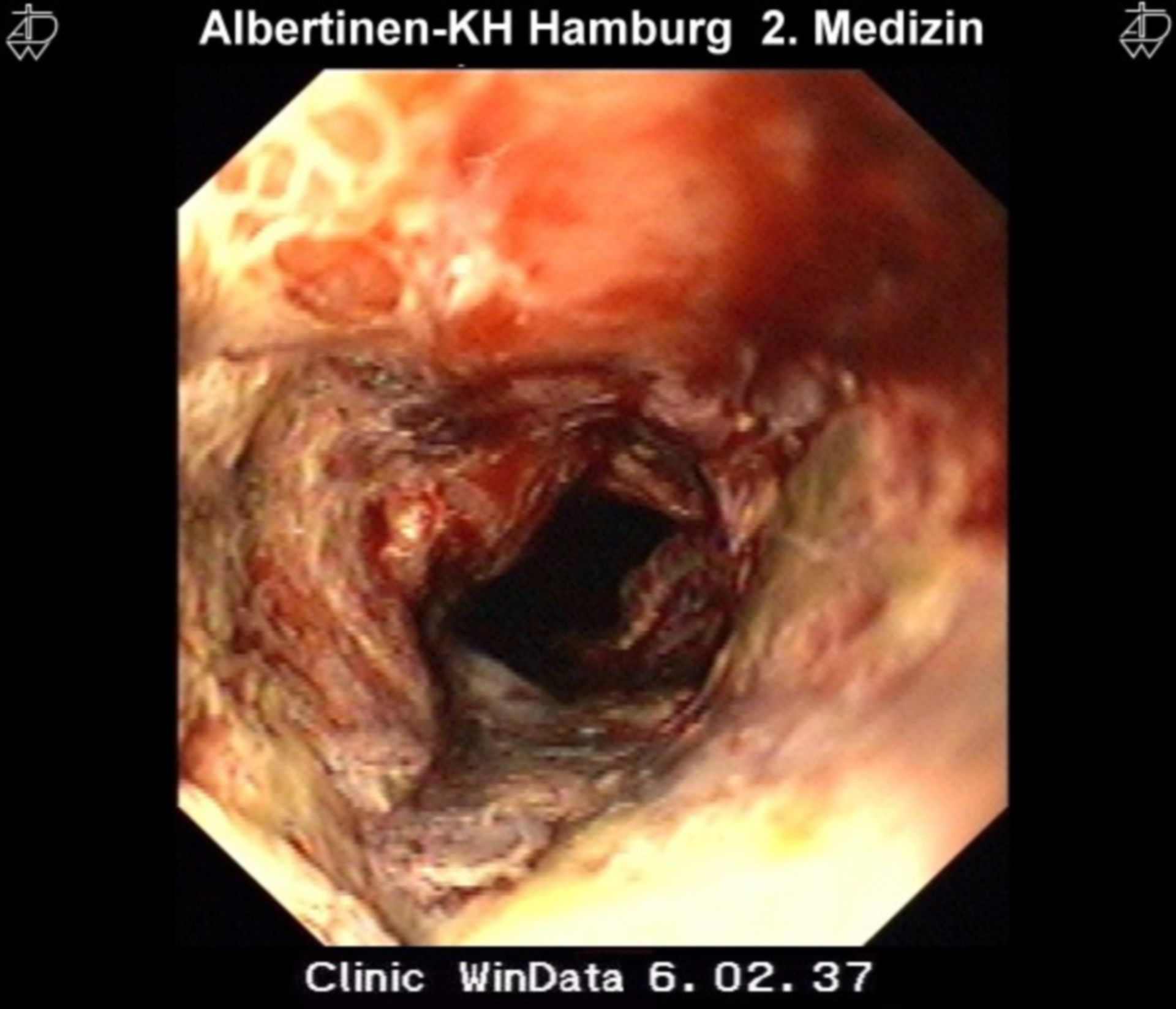 Squamous cell carcinoma