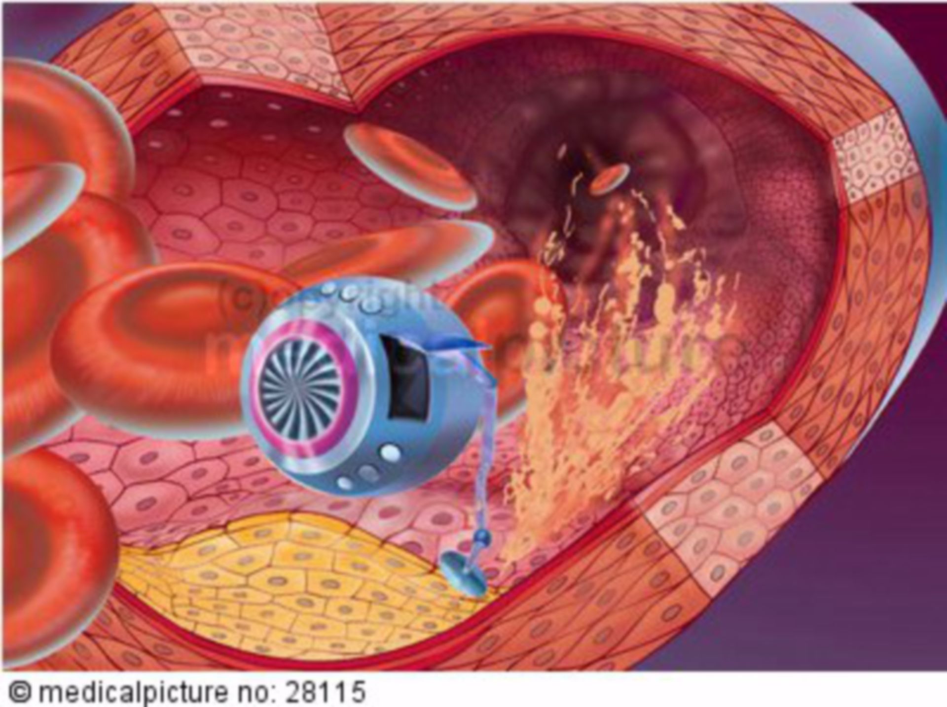  Nanoroboter bei Arterienreinigung 
