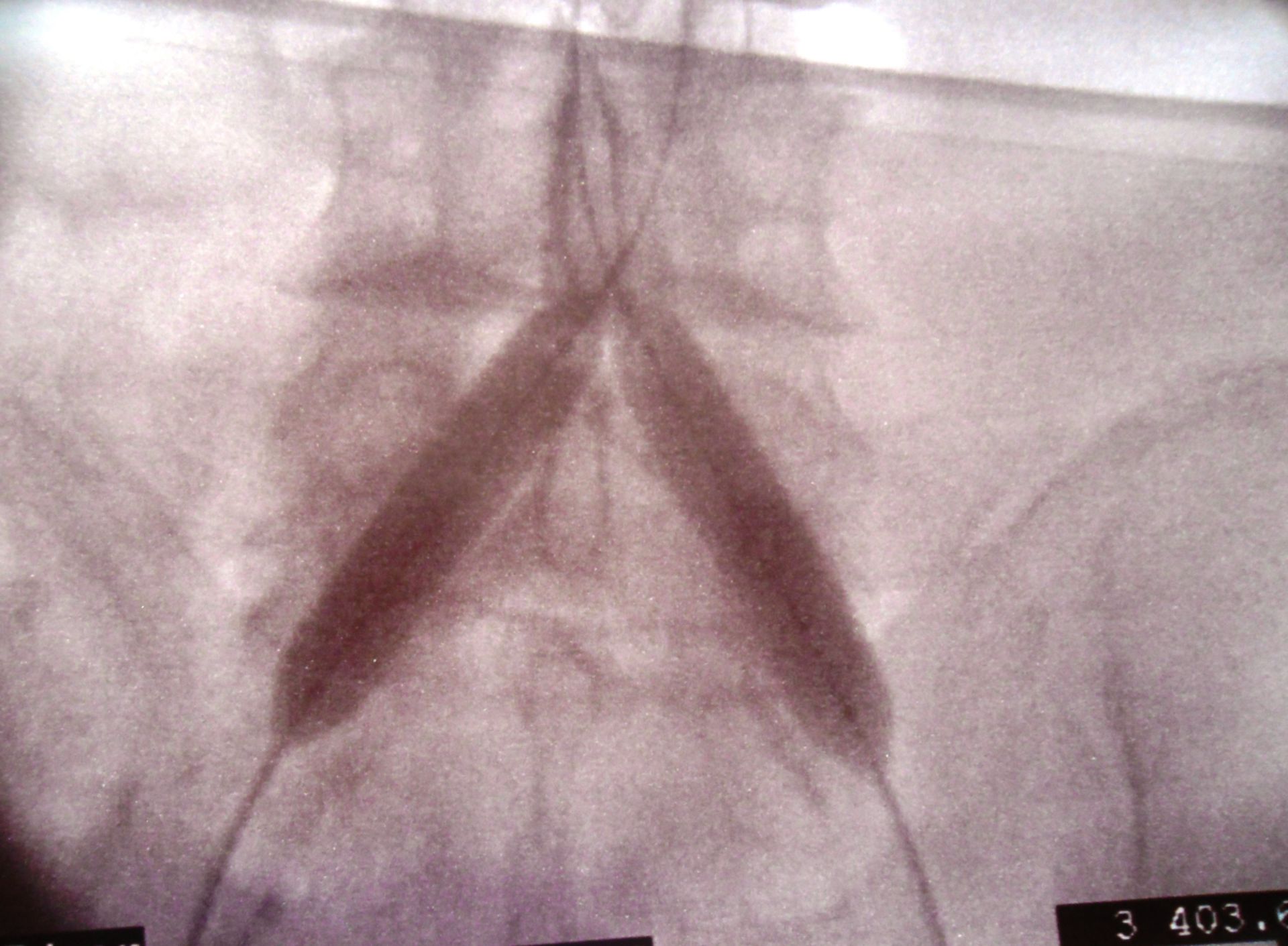 PTA dell'arteria iliaca comune con tecnica a mongolfiera