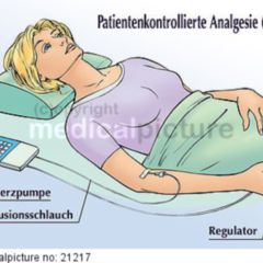 Patientenkontrollierte Analgesie - DocCheck Flexikon