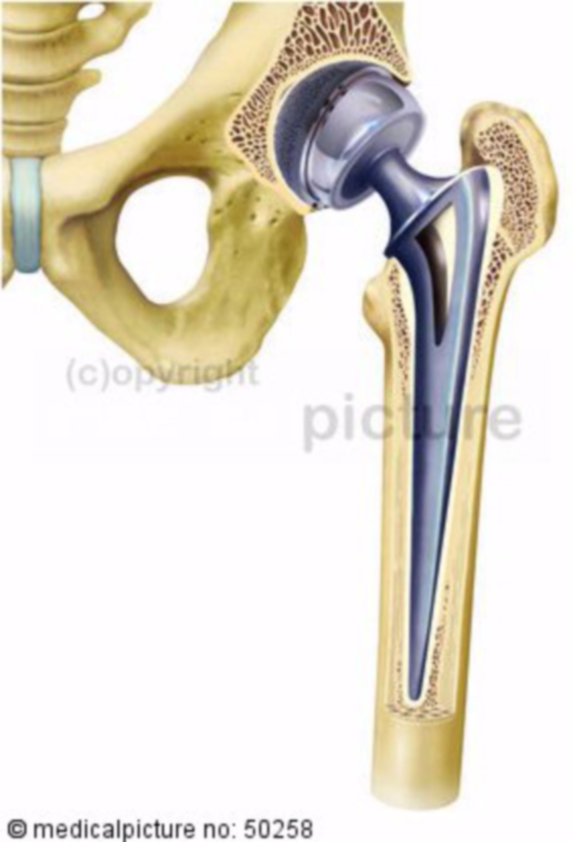 Artificial hip joint, endoprothesis