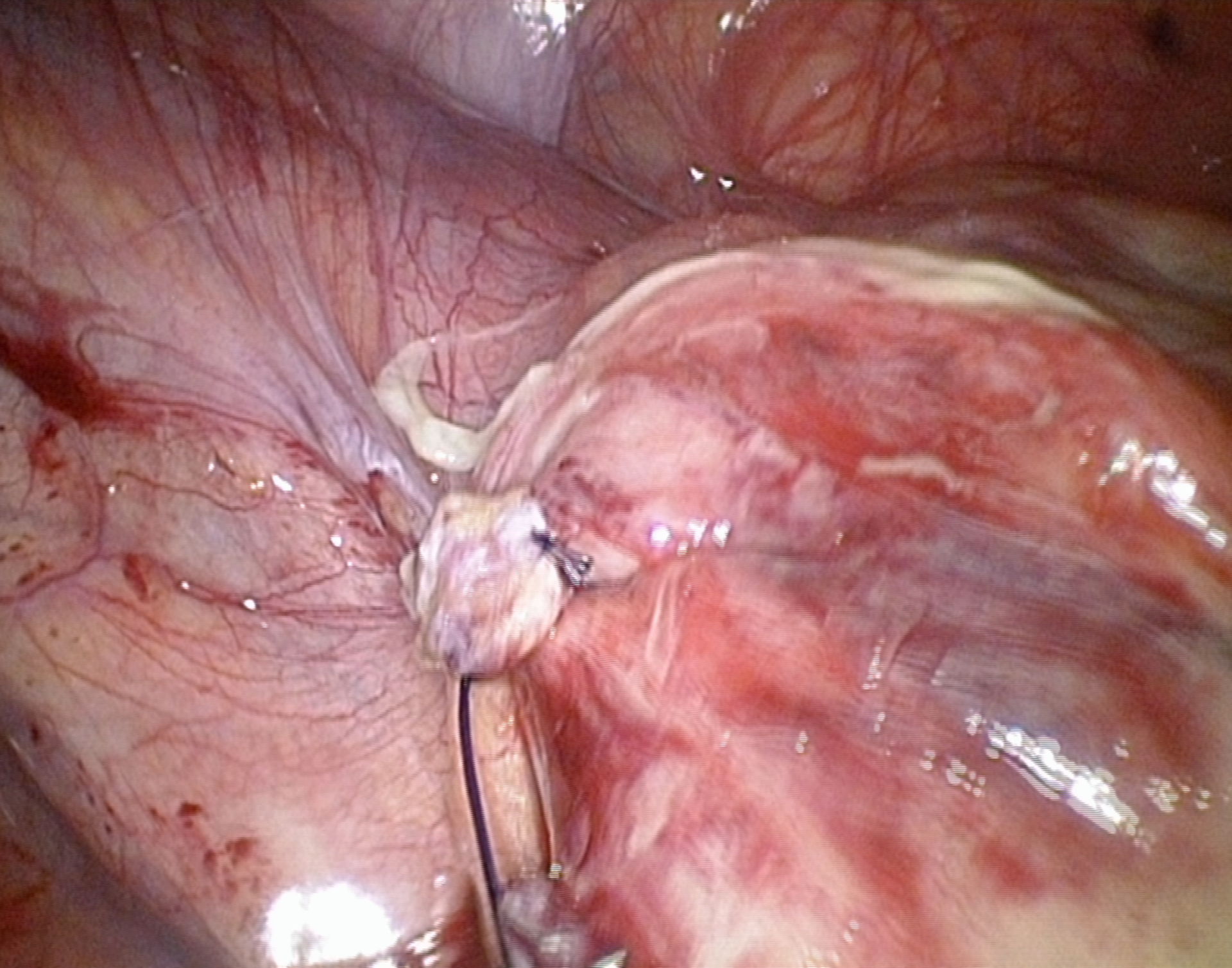 Perforated appendicitis - Area of ablation