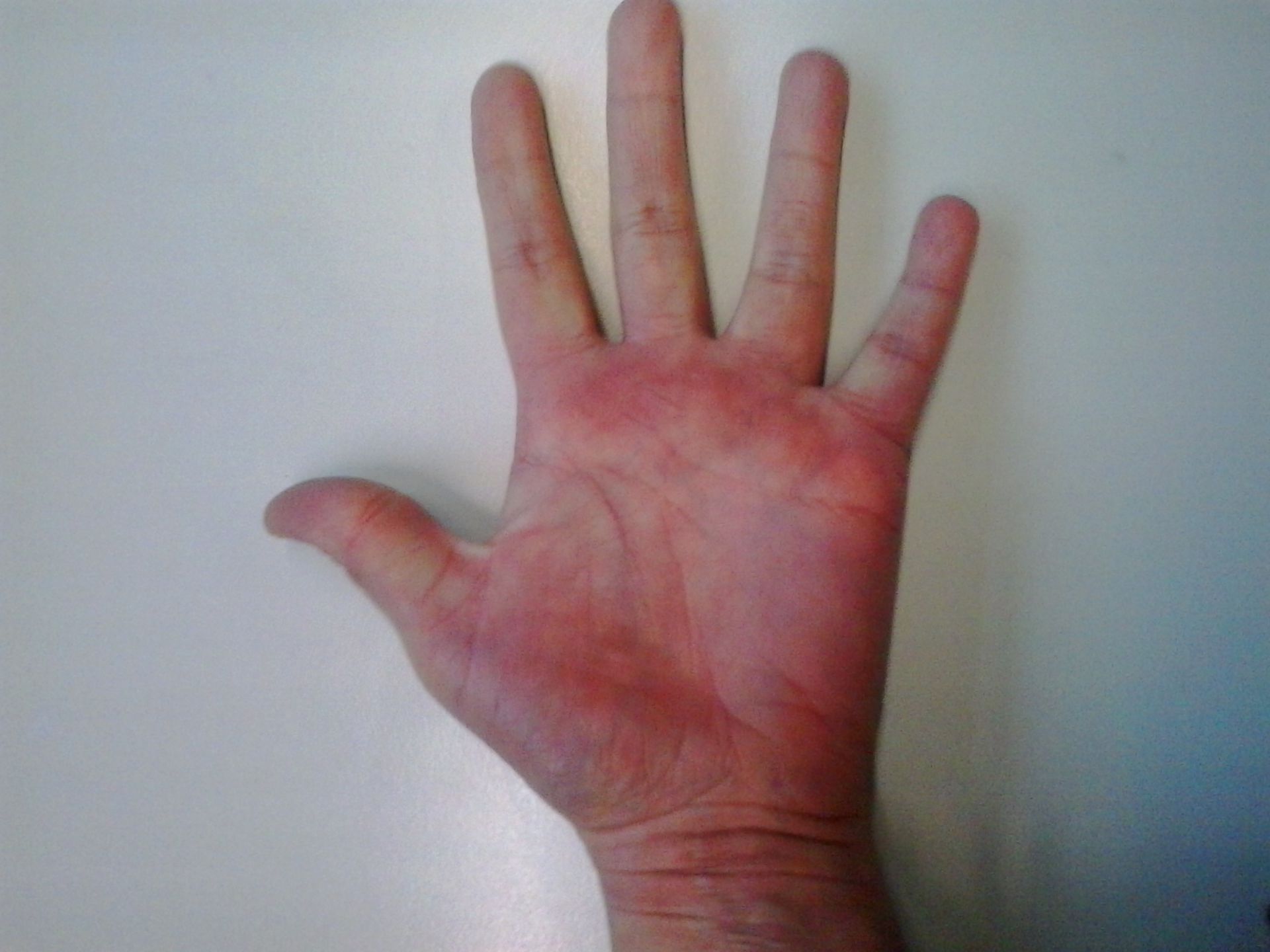 Unbekannte Rötung linke Hand (2)