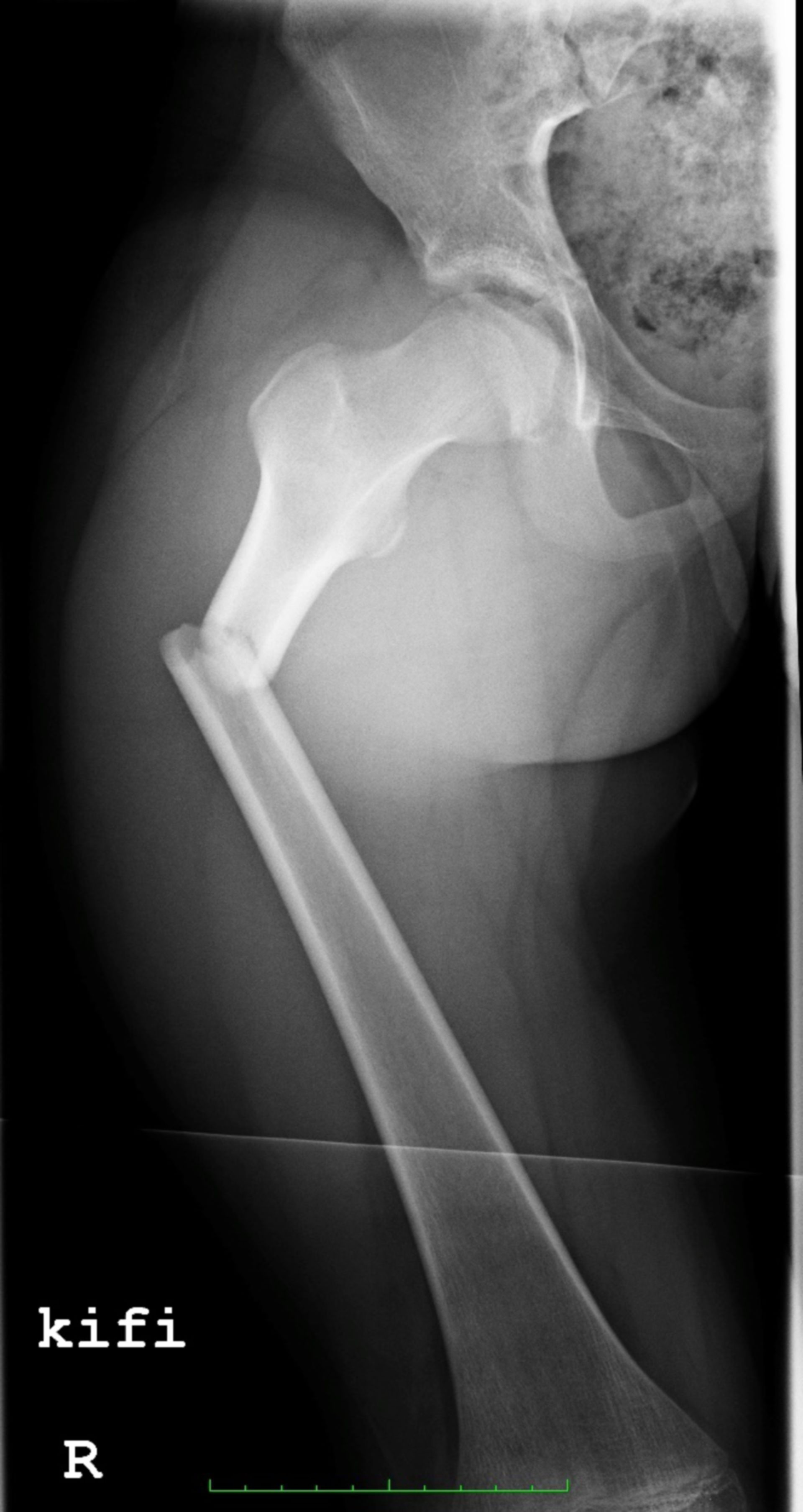 Röntgen des Oberschenkels mit Femurfraktur im proximalen Drittel (10-jähriges Kind)