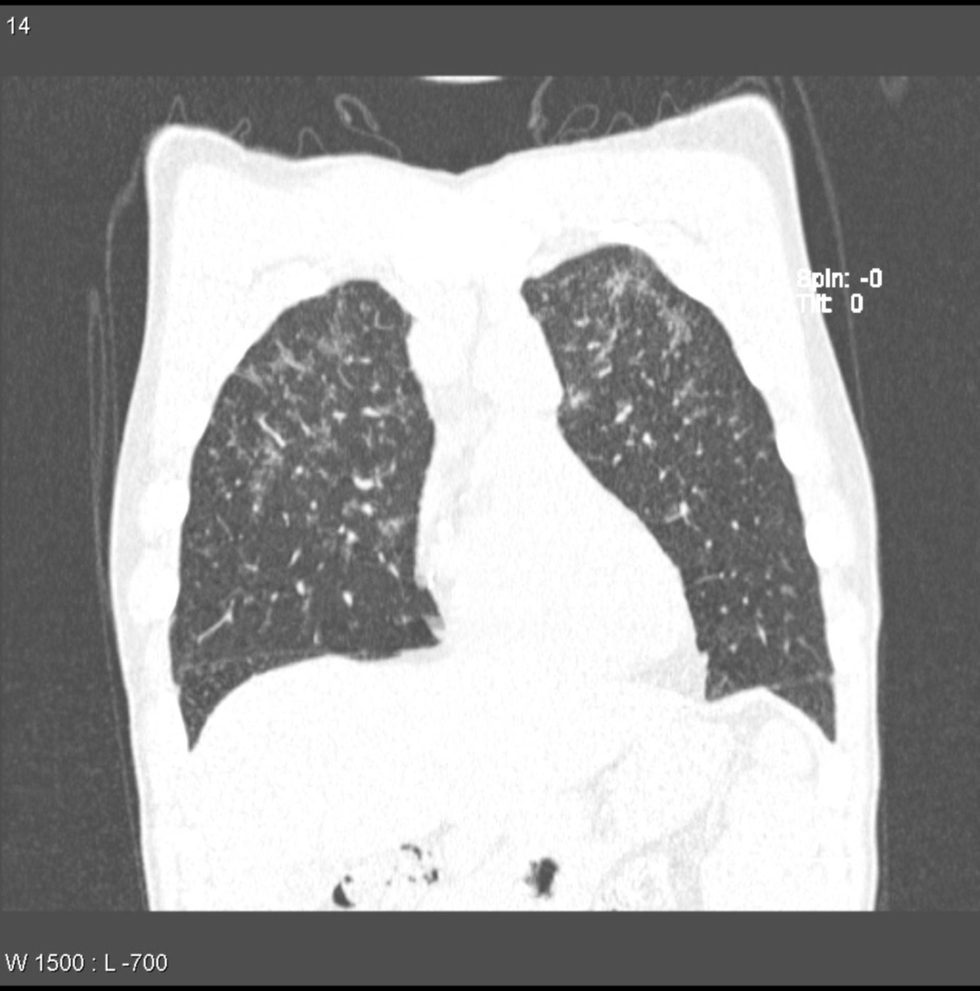 Sarcoidosis, lung