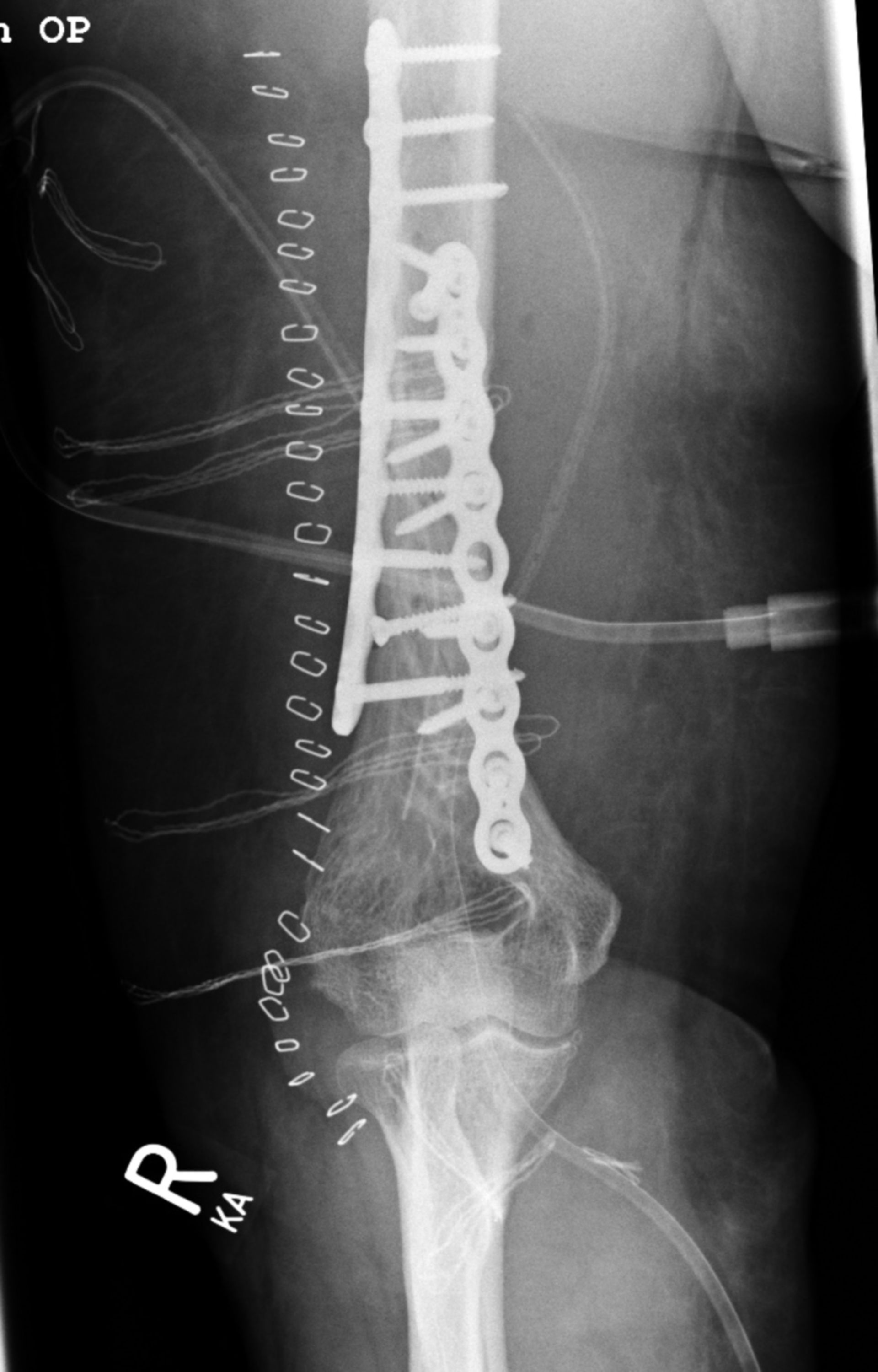 Supracondylar humerus fracture - after surgery