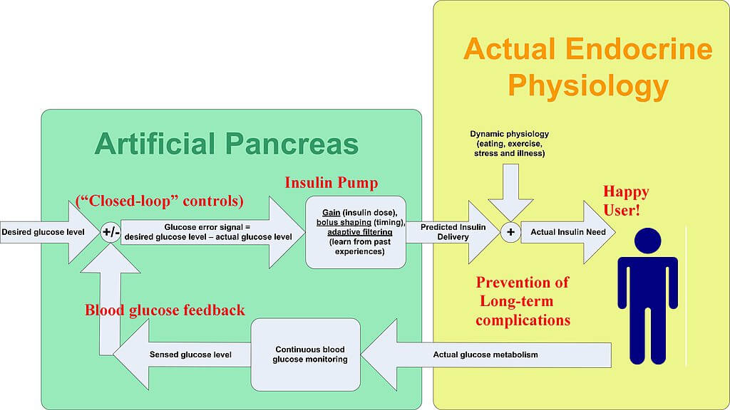 artificial_pancreas_original.jpg
