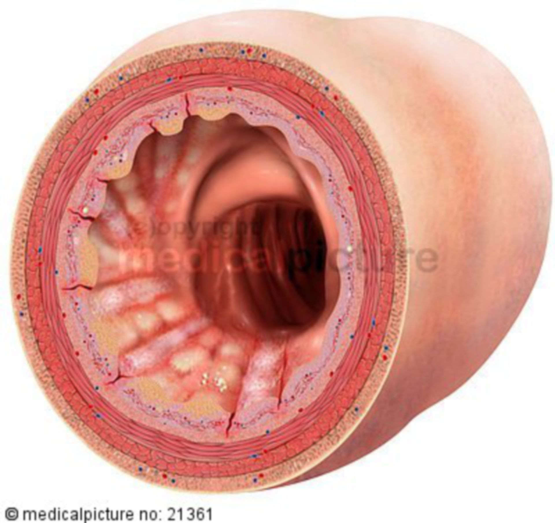 Lumen of a colon with Morbus Crohn