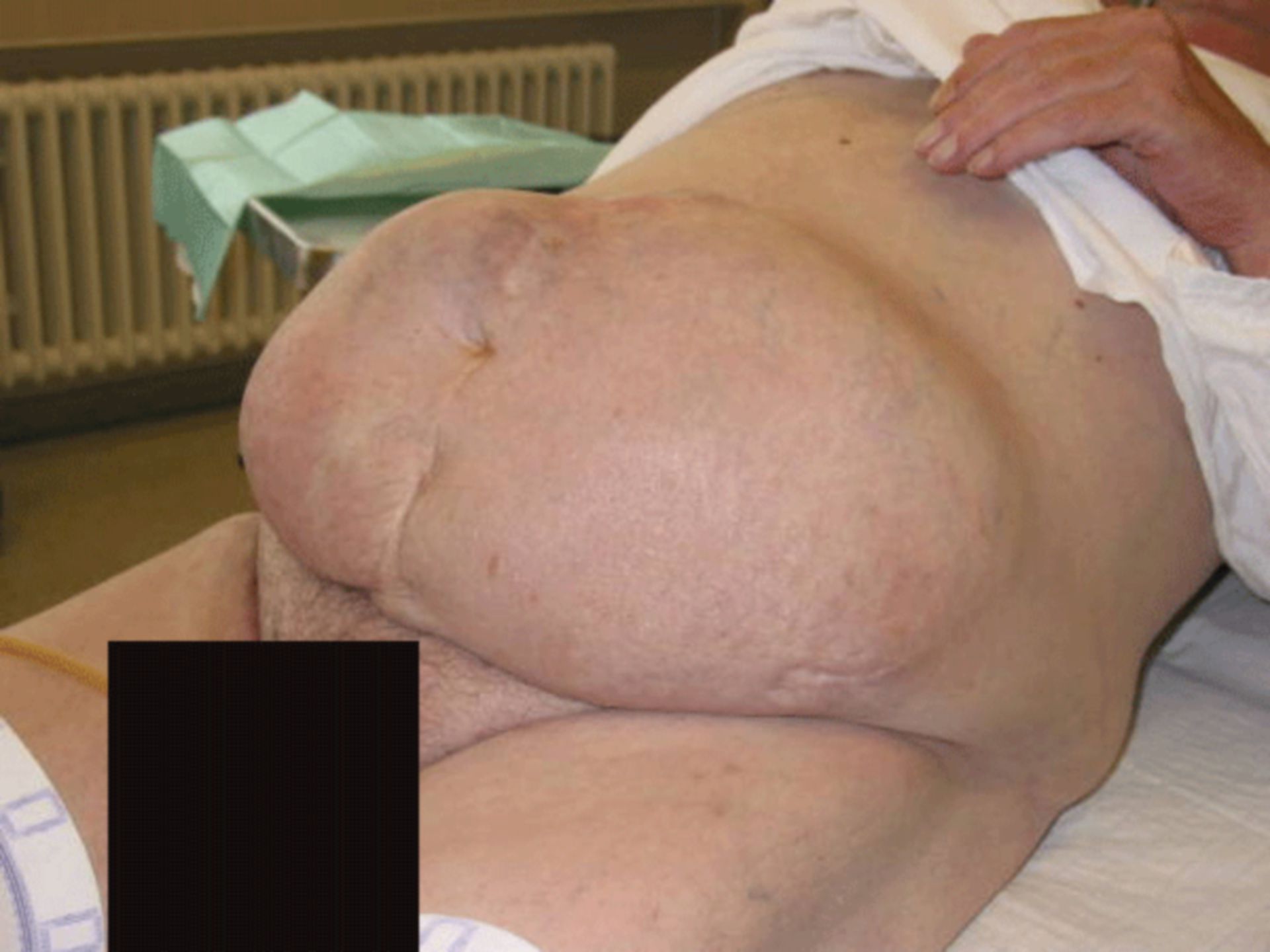 Hernia, abdomen agudo y perforación del intestino delgado