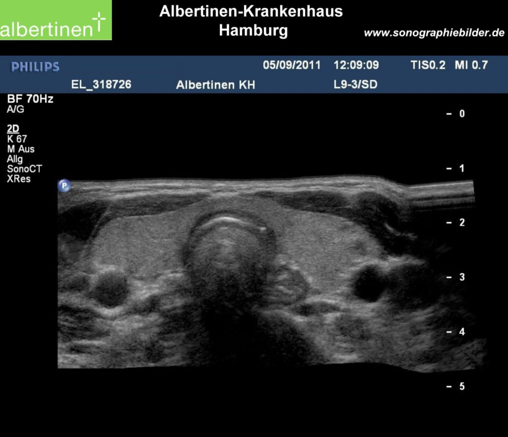 Ultrasonographic normal finding of the thyroid gland