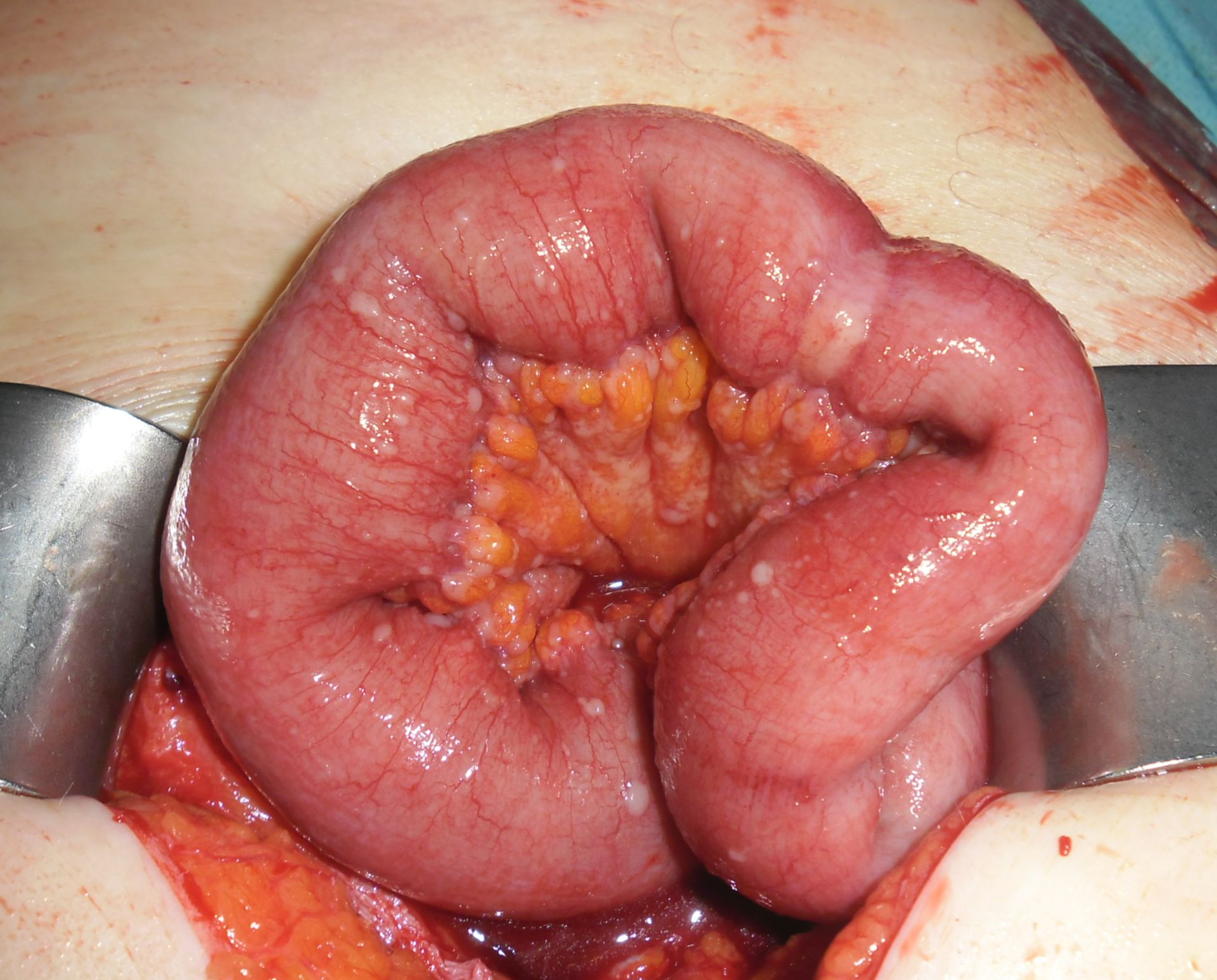 Peritoneal Carcinose