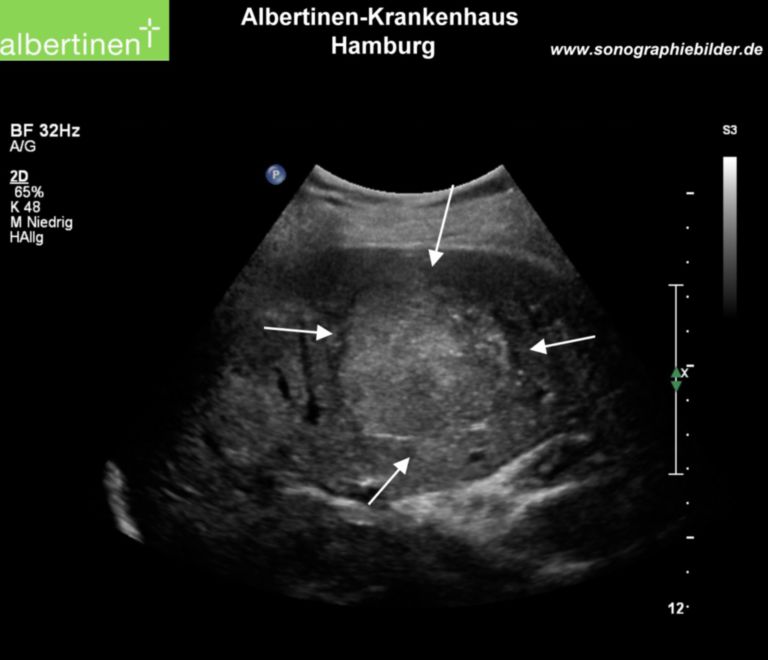 Sonography: HCC of the liver - DocCheck