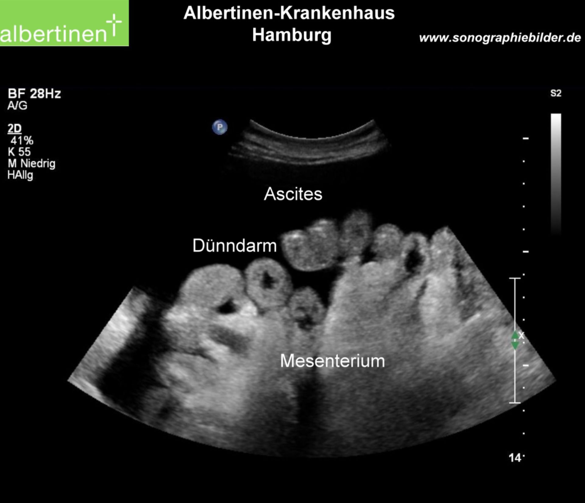 Peritoneal carcinomatosis, ascites, ultrasound