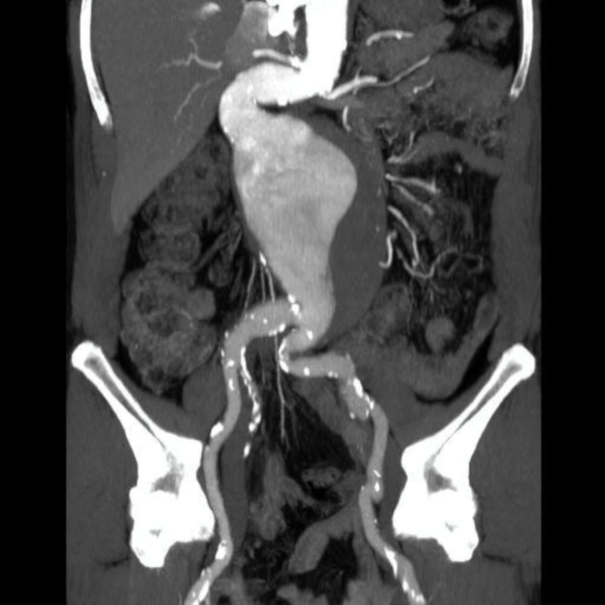 Aneurysma der Aorta abdominalis