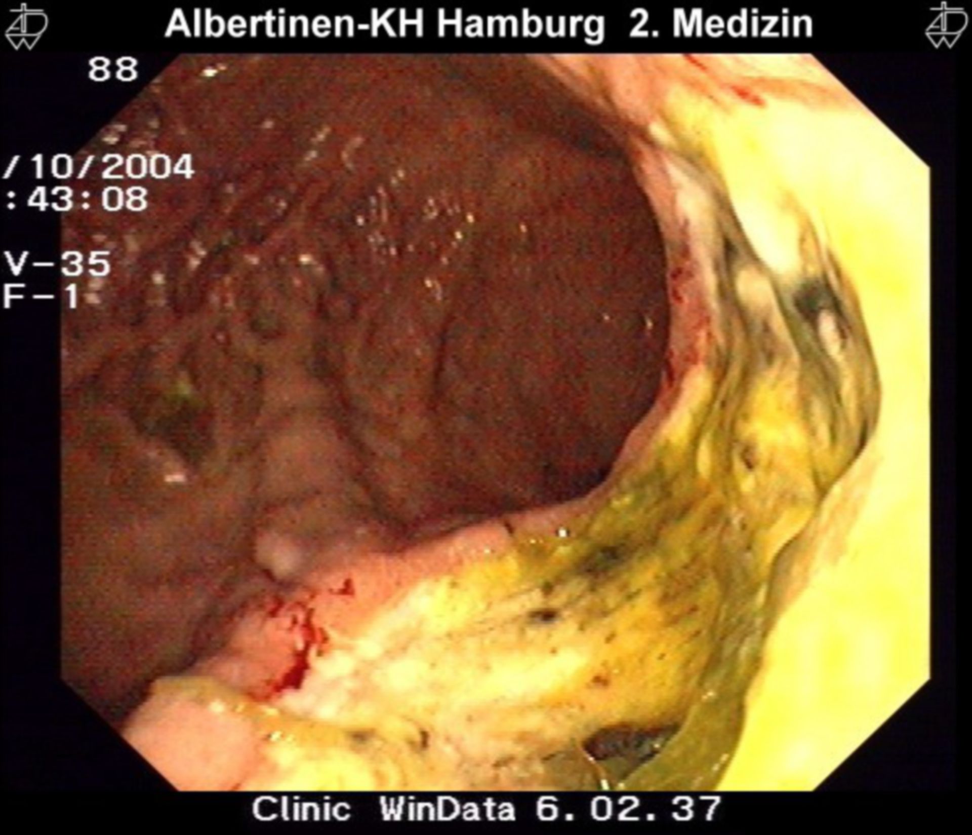 Large ulcer