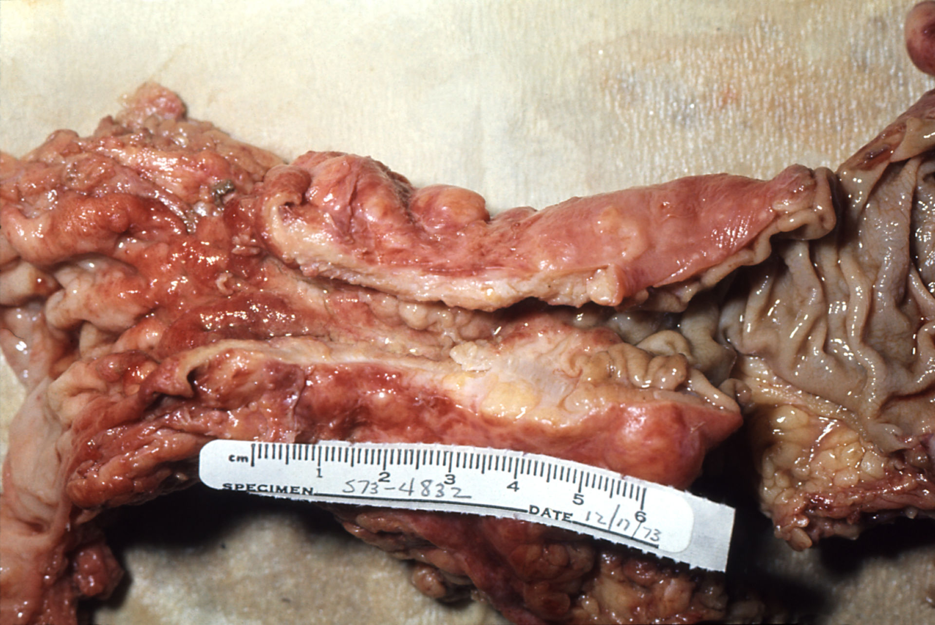 Pathology of adenocarcinoma