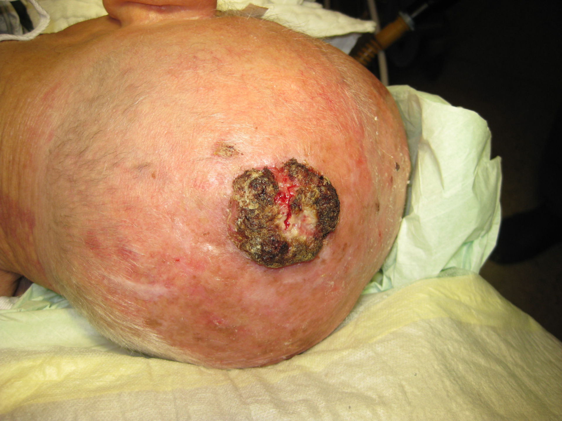 Carcinoma de células escamosas