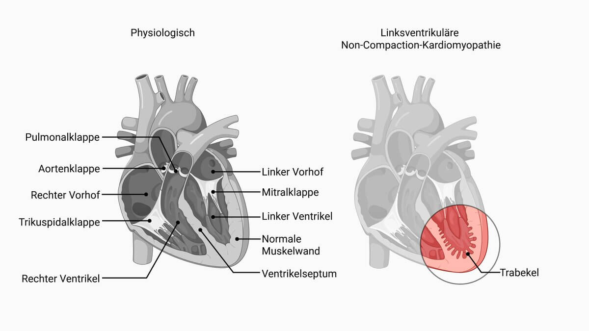Linksventrikuläre Non-Compaction-Kardiomyopathie