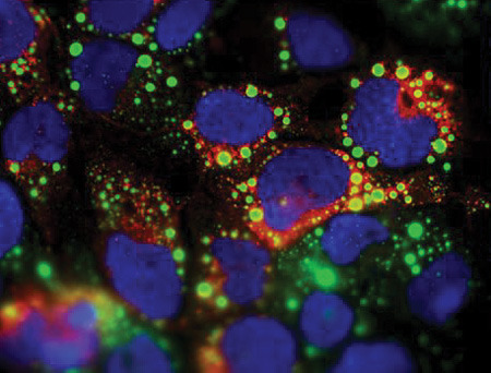 HCV-infizierte Zellen: An den grünen Fetttröpfchen werden die Viren zusammengebaut. © TWINCORE/ Pietschmann