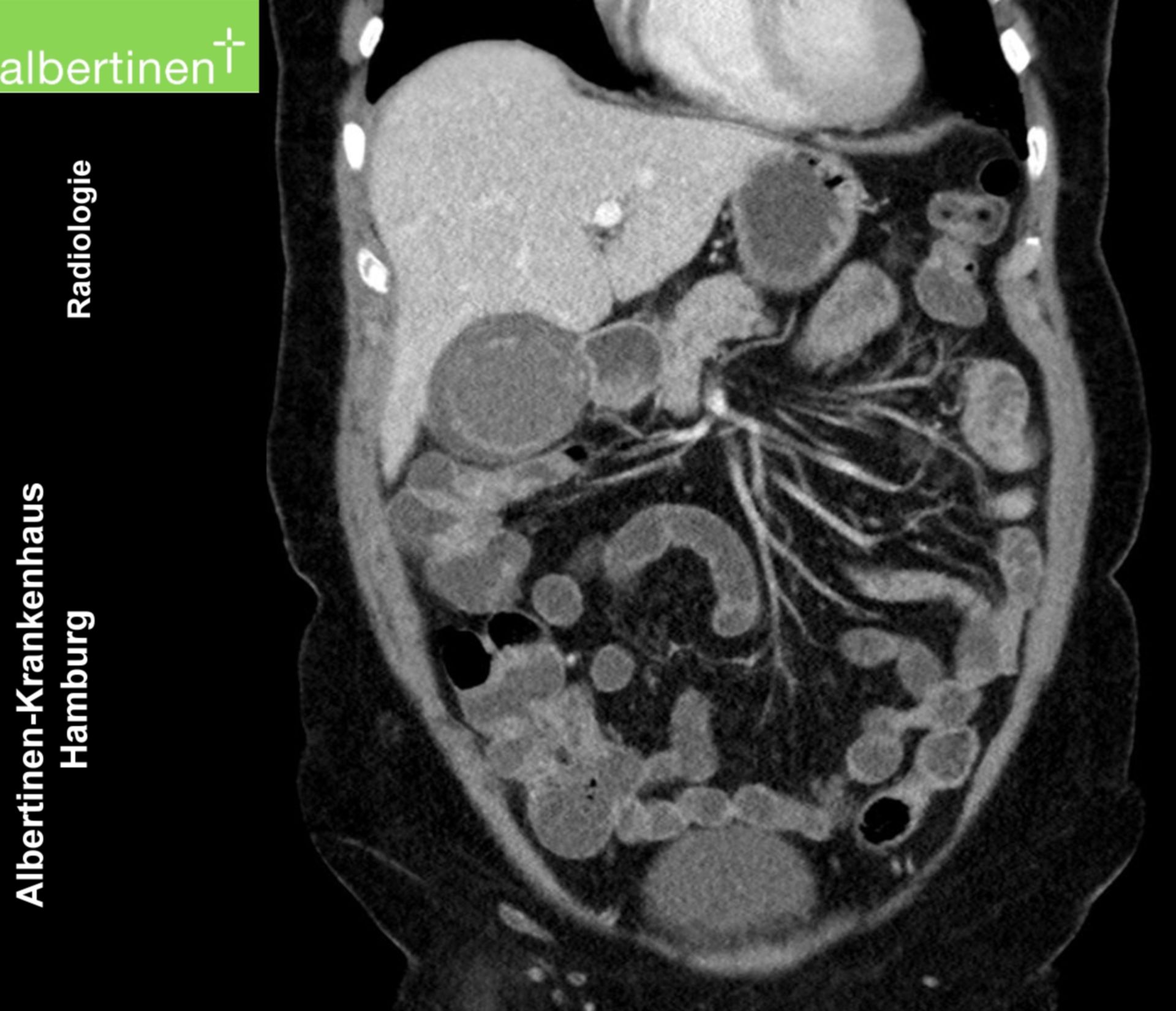 CT Cholezystitis coronar