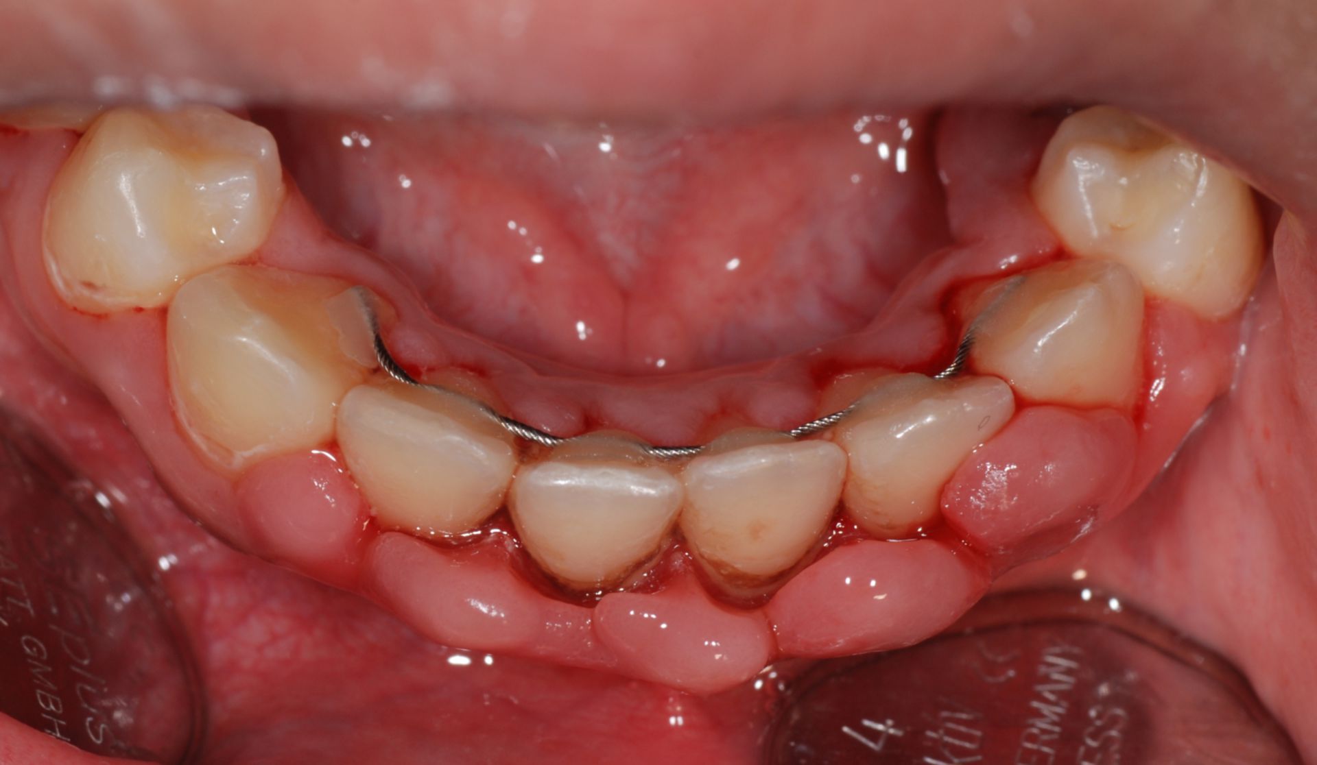 Gingivahyperplasie Unterkieferfront