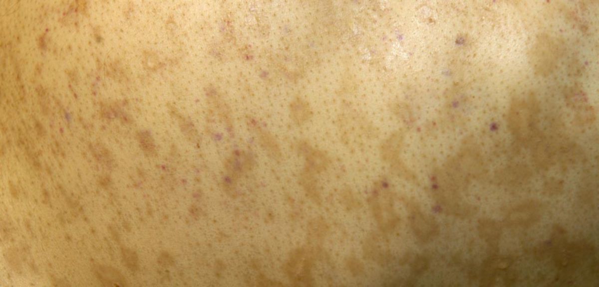 Akute Graft-versus-Host-Erkrankung der Haut
