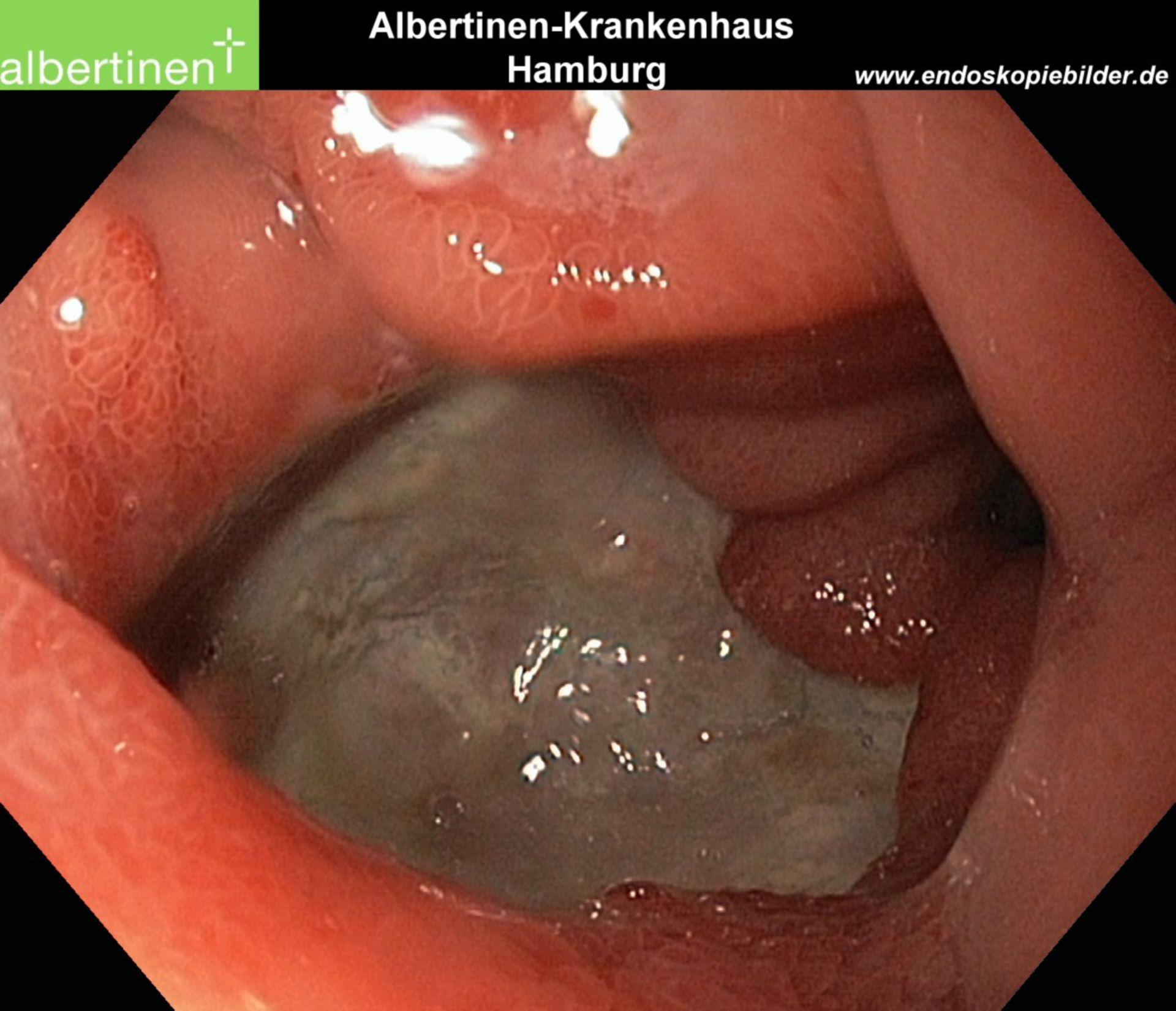 Penetrating duodenal ulcer