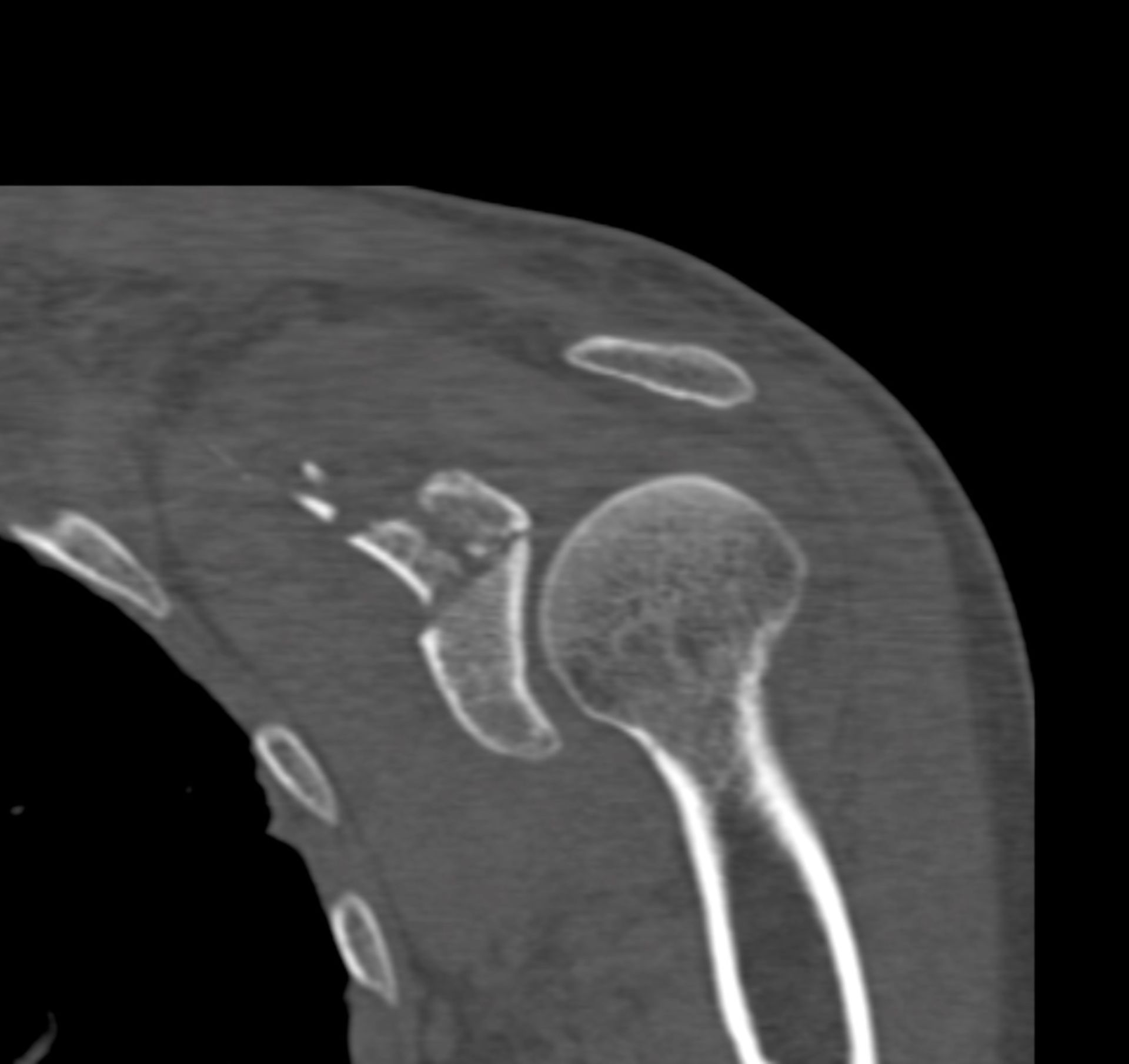 CT der Schulter in koronarer Ebene mit Scapulafraktur mit Glenoidbeteiligung
