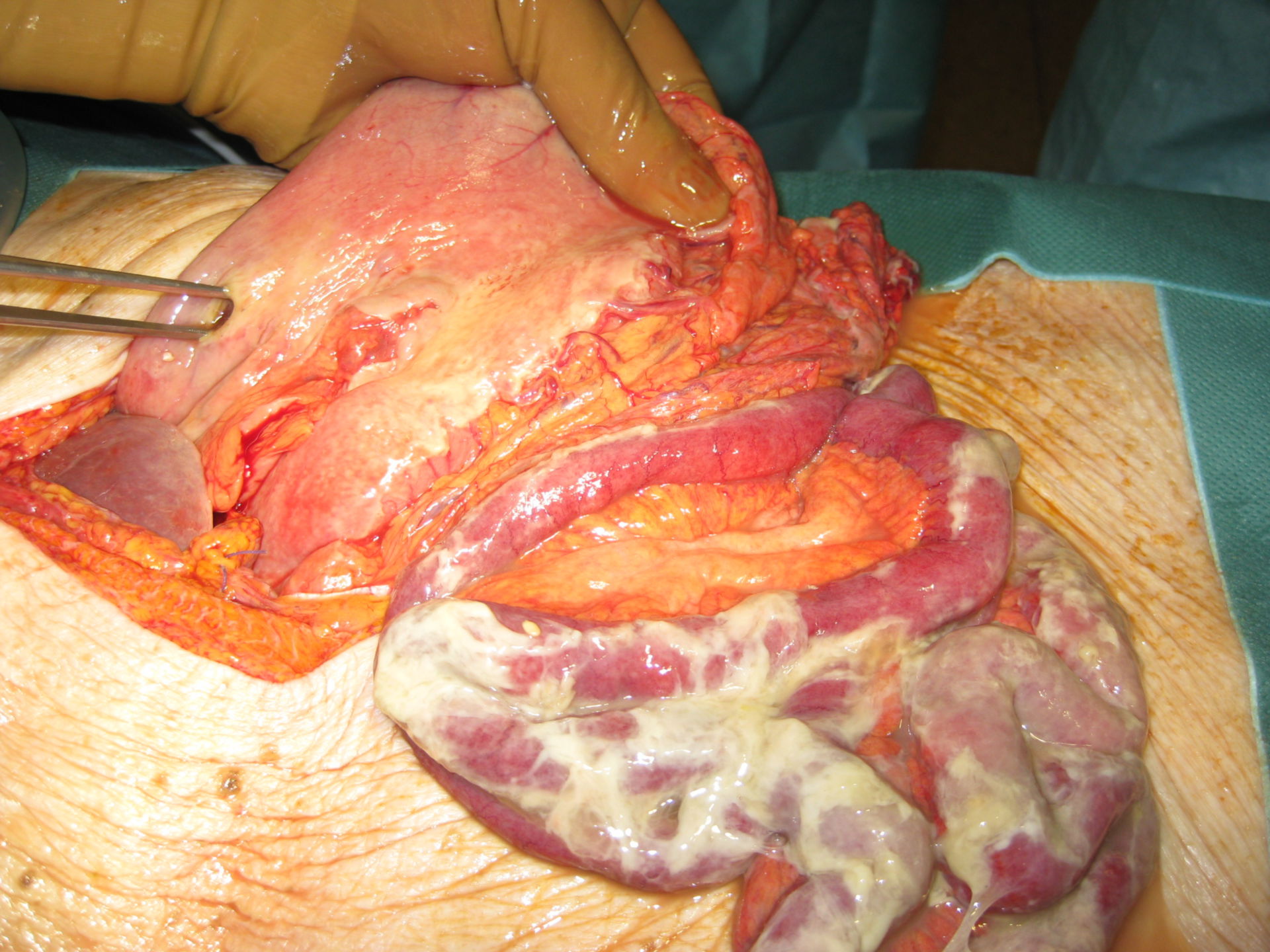 Perforación gástrica que conlleva a una peritonitis difusa
