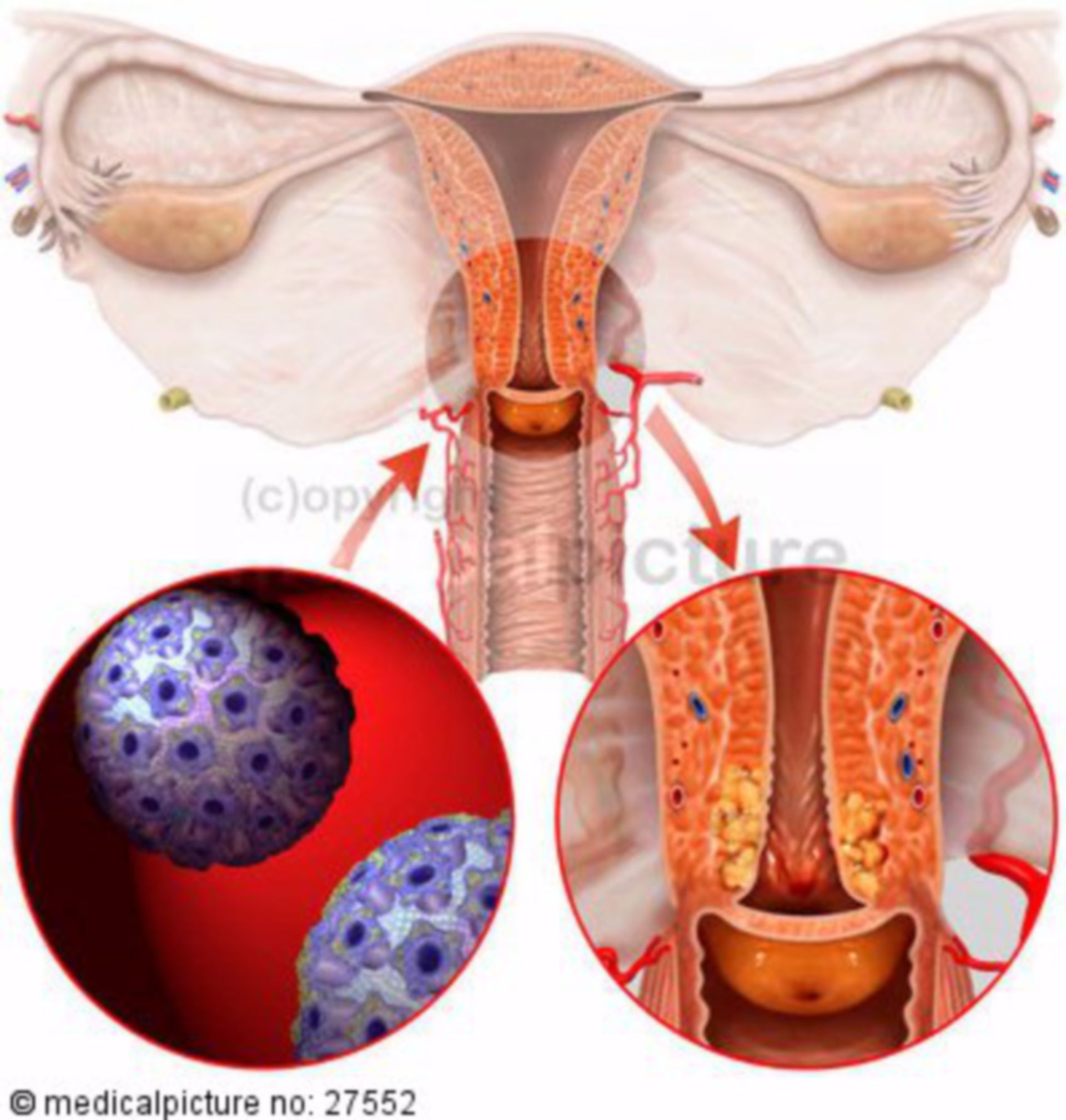 Cervical carcinoma