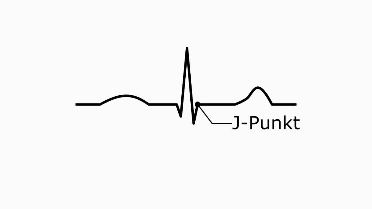 Schematische EKG-Abbildung mit markiertem J-Punkt
