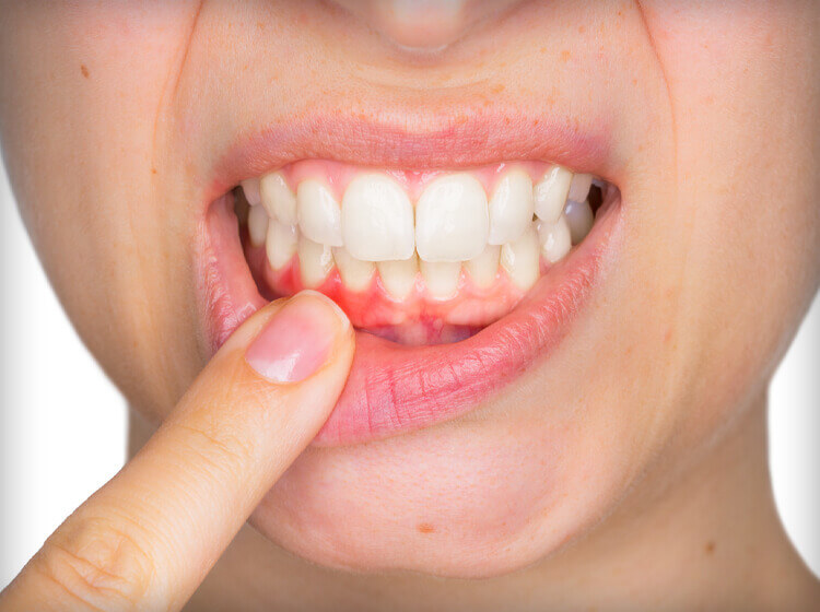everything_you_need_to_know_about_gingivitis_original.jpg