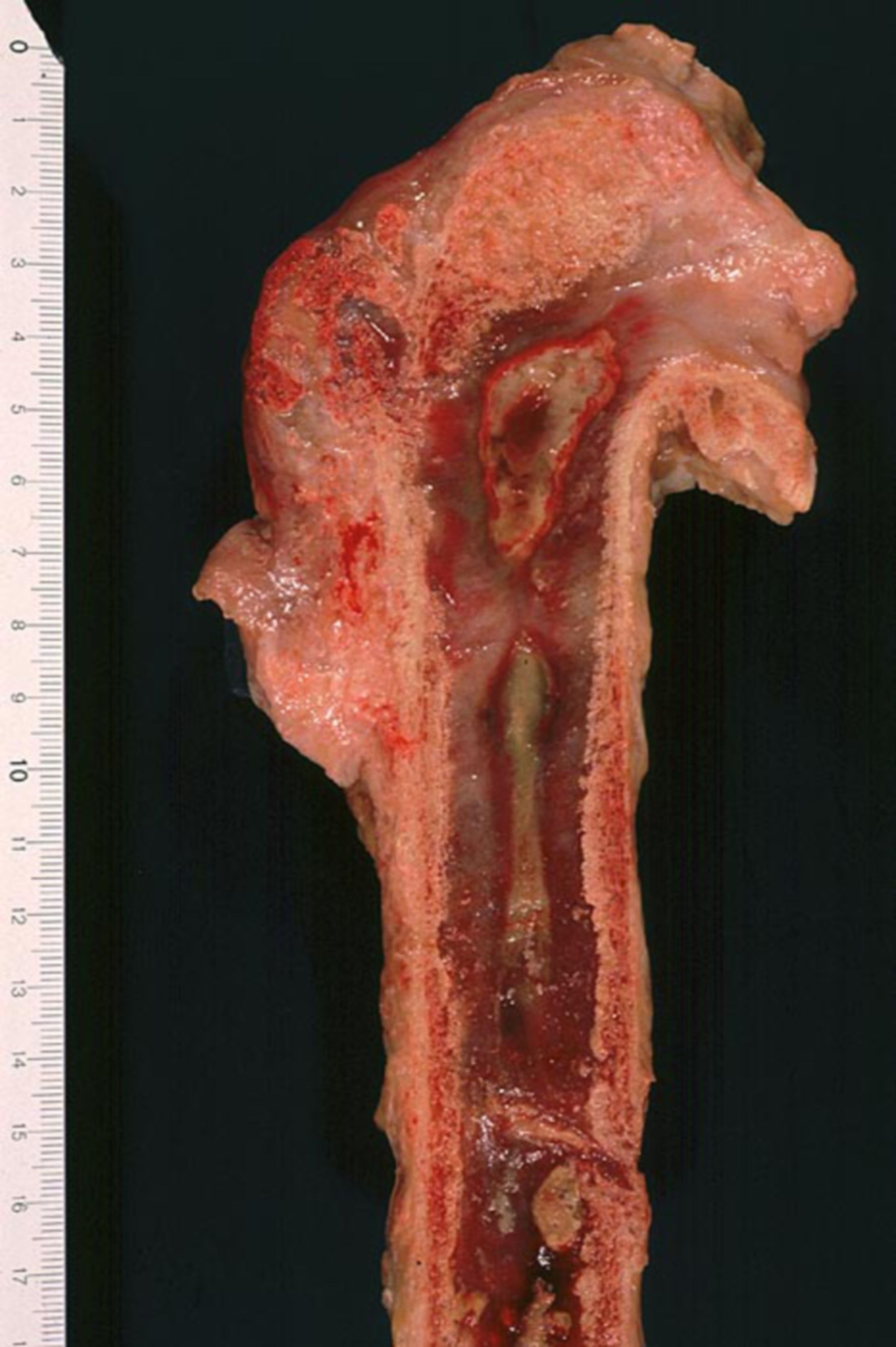 Floride chronic osteomyelitis