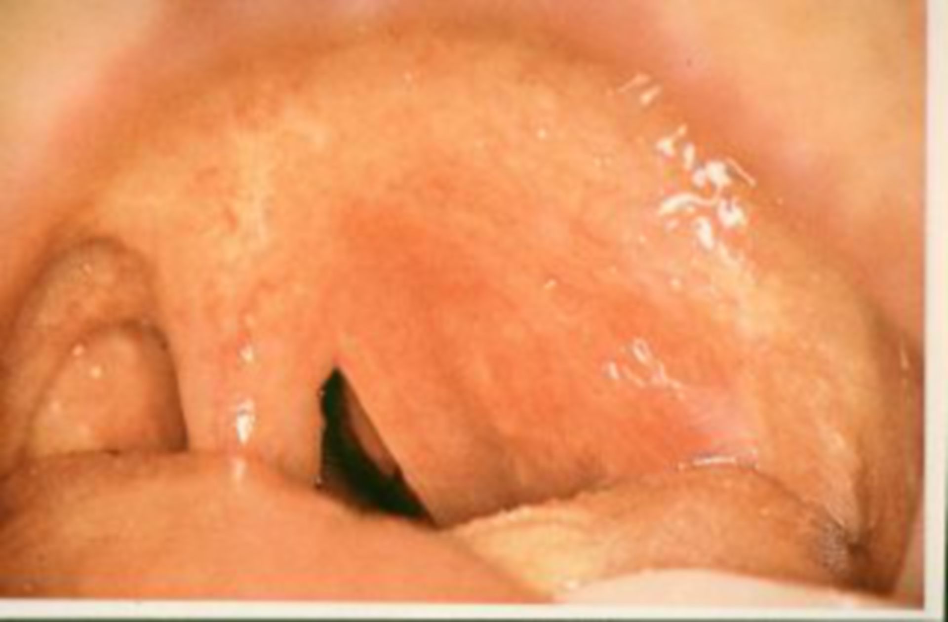 Peritonsillar abscess