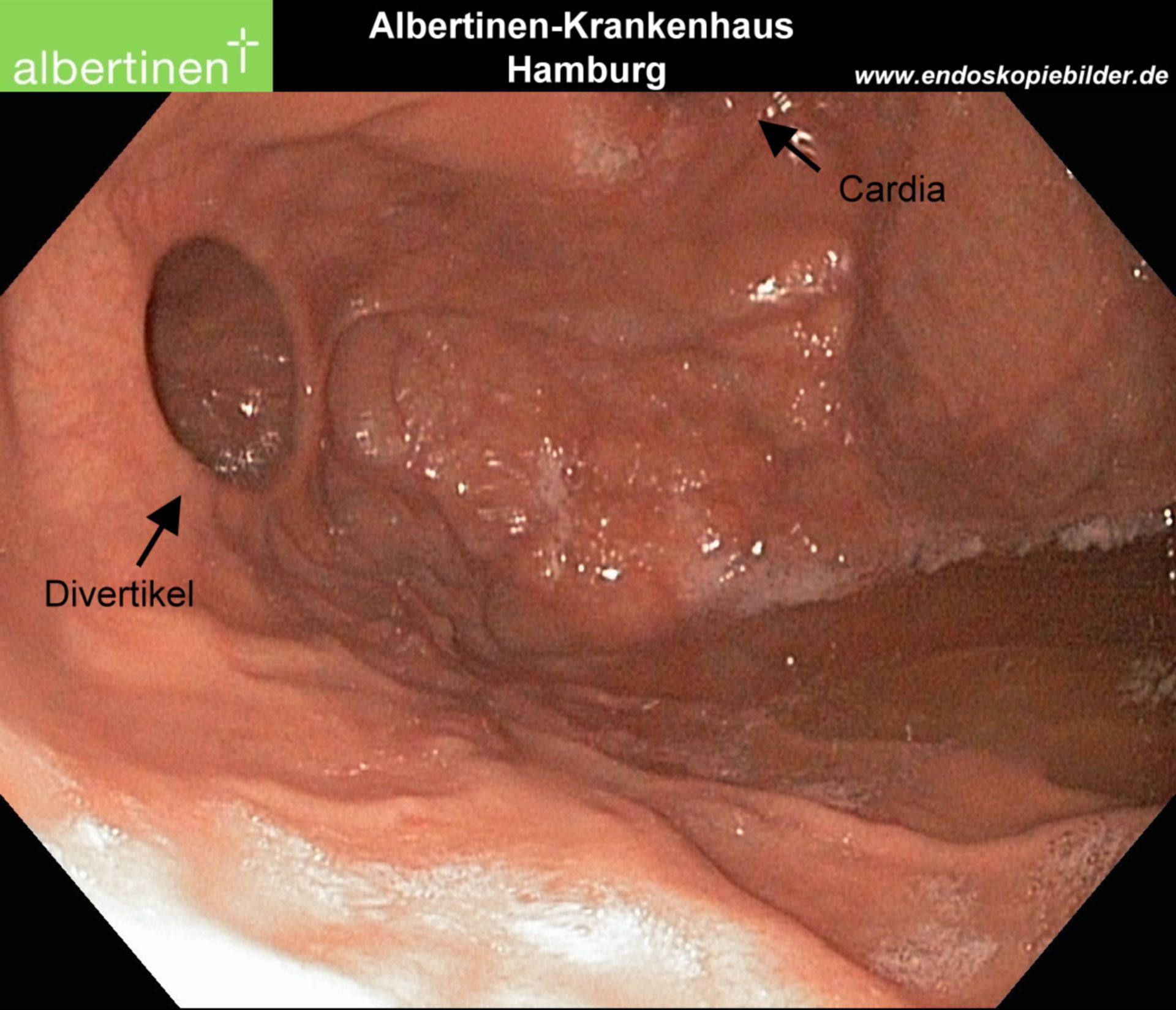 Gastric fundus diverticulum endoscopy arrows