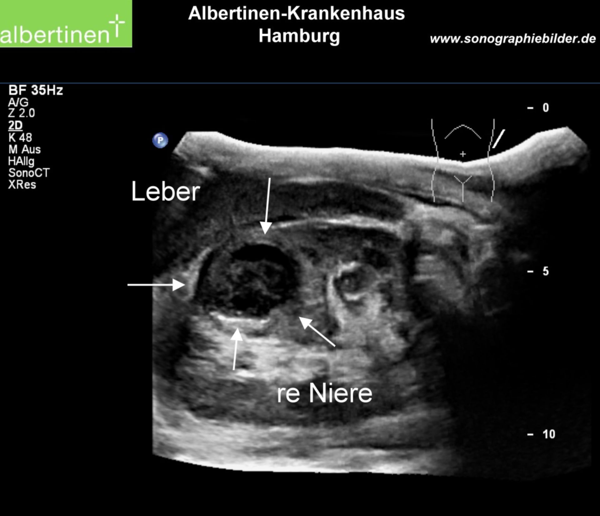 Renal abscessus