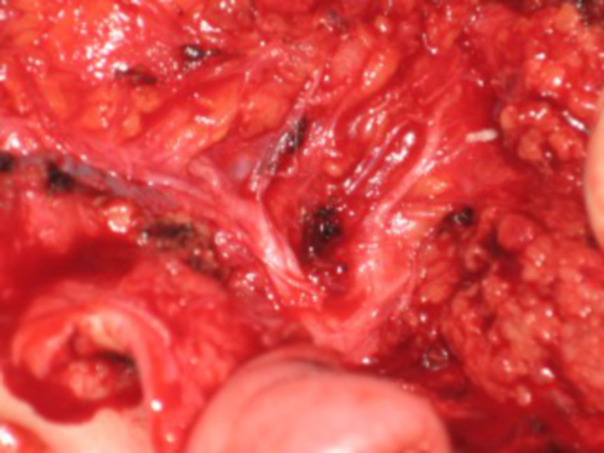 Speicheldrüsen-Operation (2)