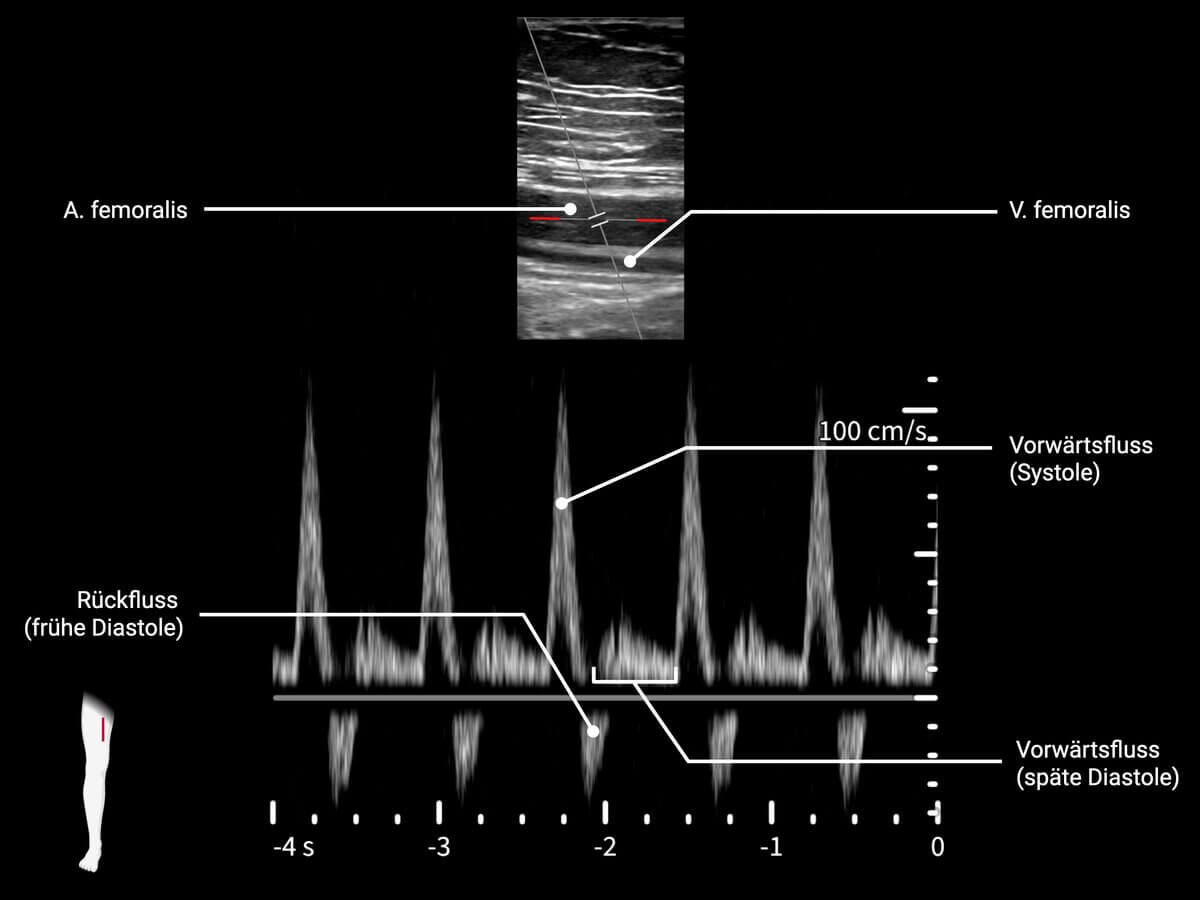 Doppler-Sonographie der A. femoralis