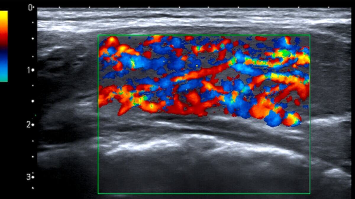 Schilddrüse im Inferno