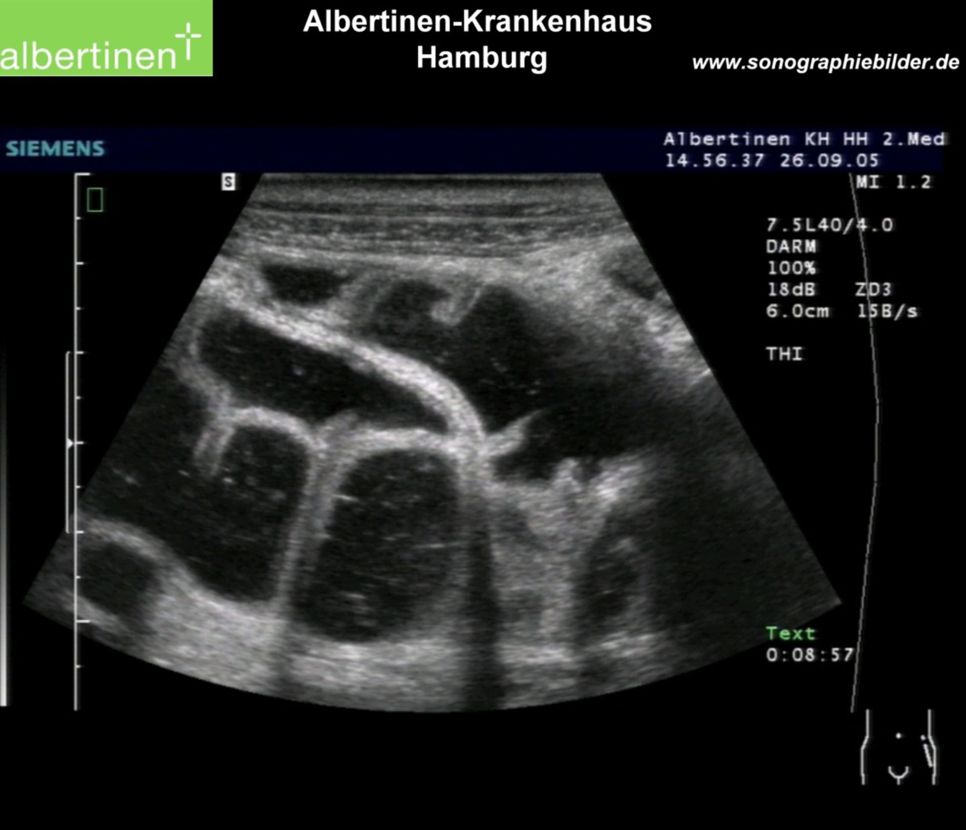 Ileus of the large intestine, ultrasonographic image