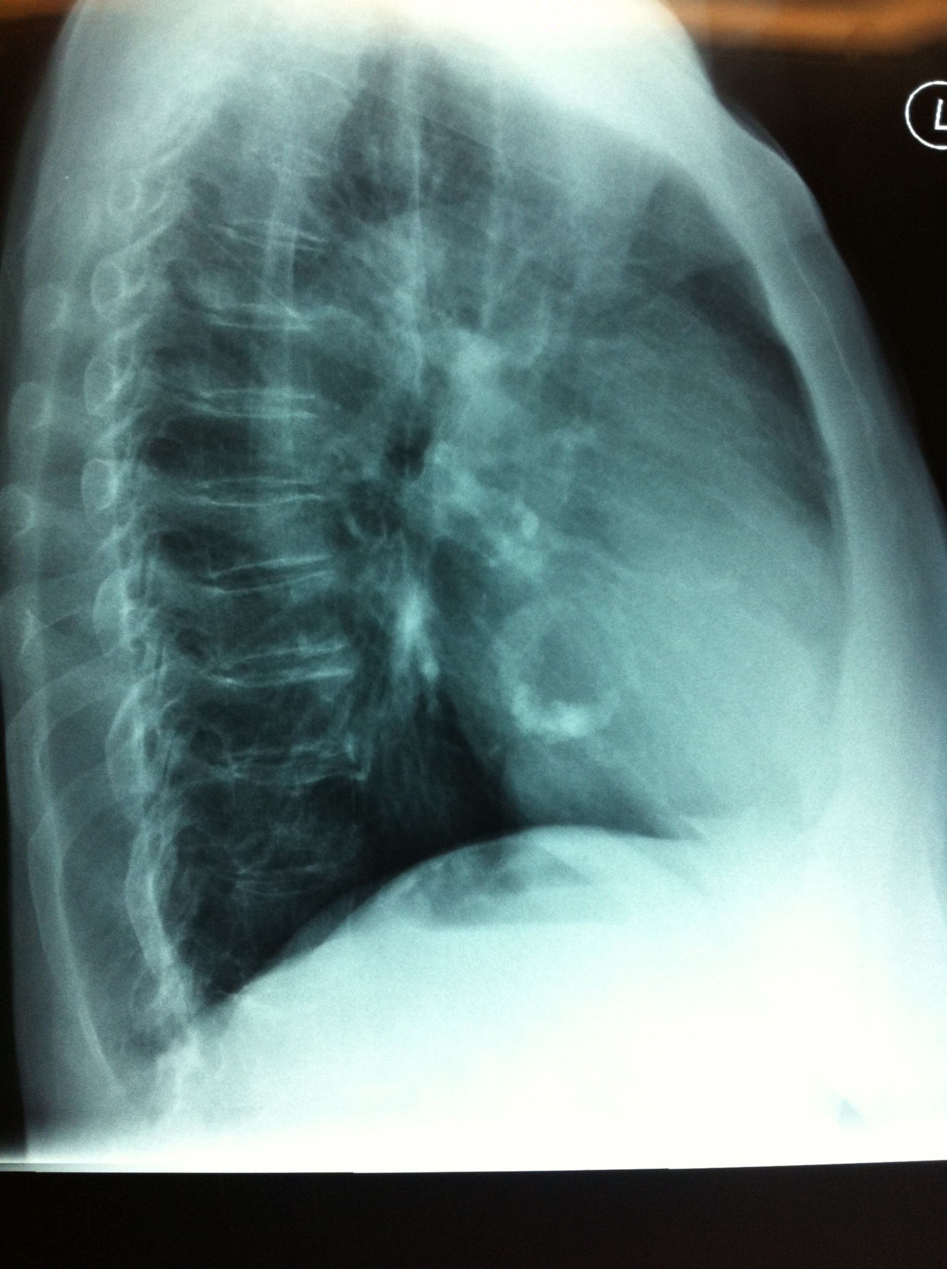 Sclerotic cardiac valve