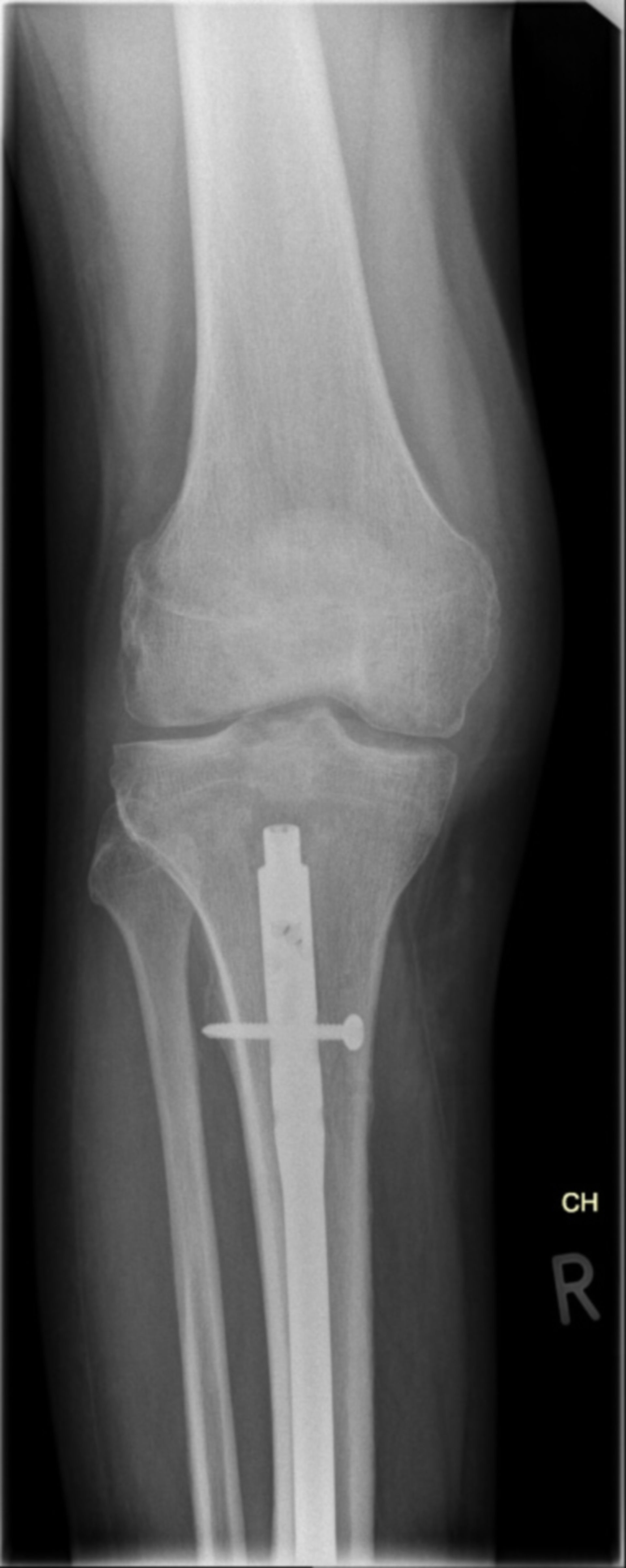 prox_us_ap_22.06.15: Röntgenaufnahme des Kniegelenkes rechts