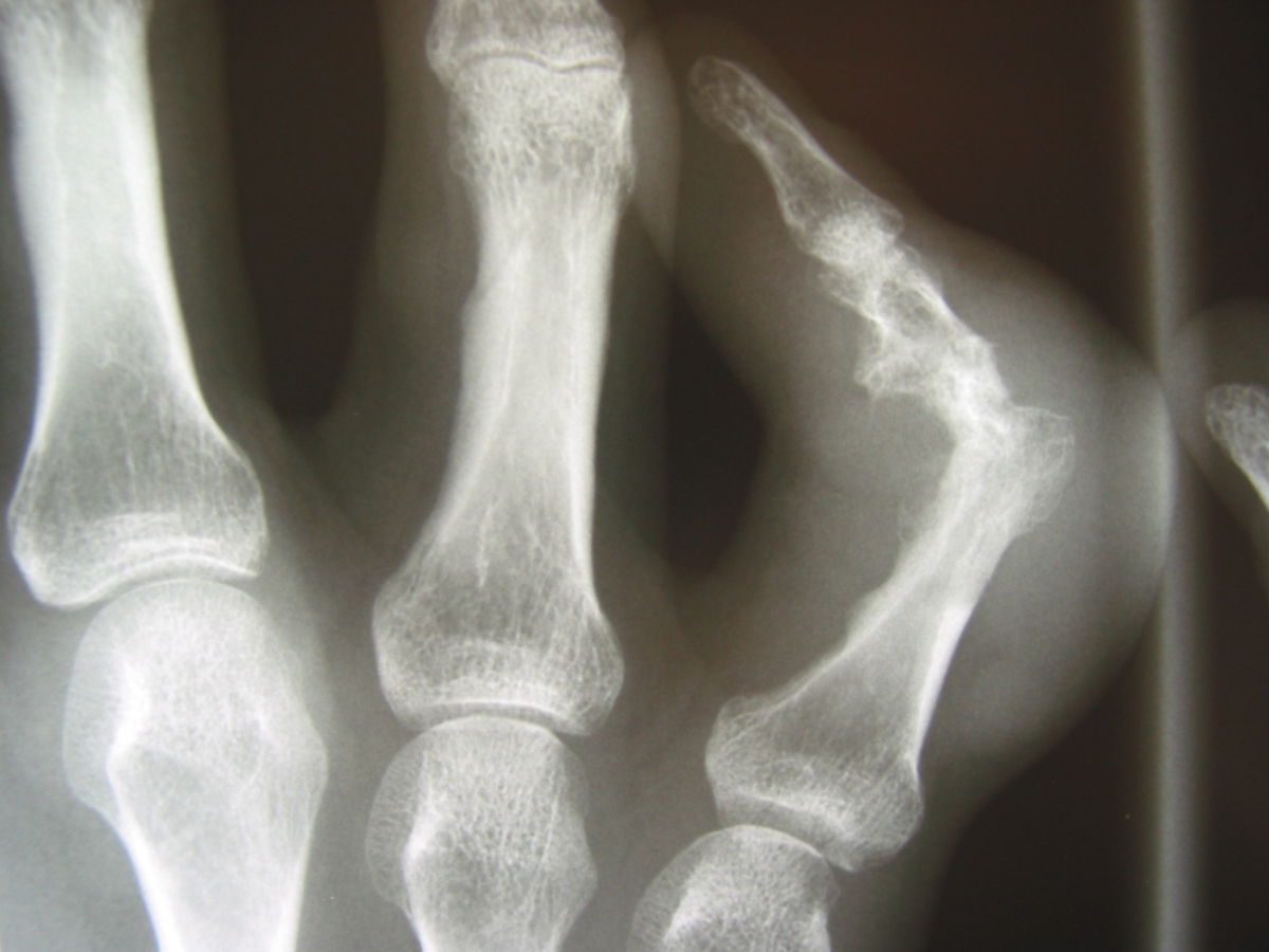 Gichtarthrose Finger Röntgenbild