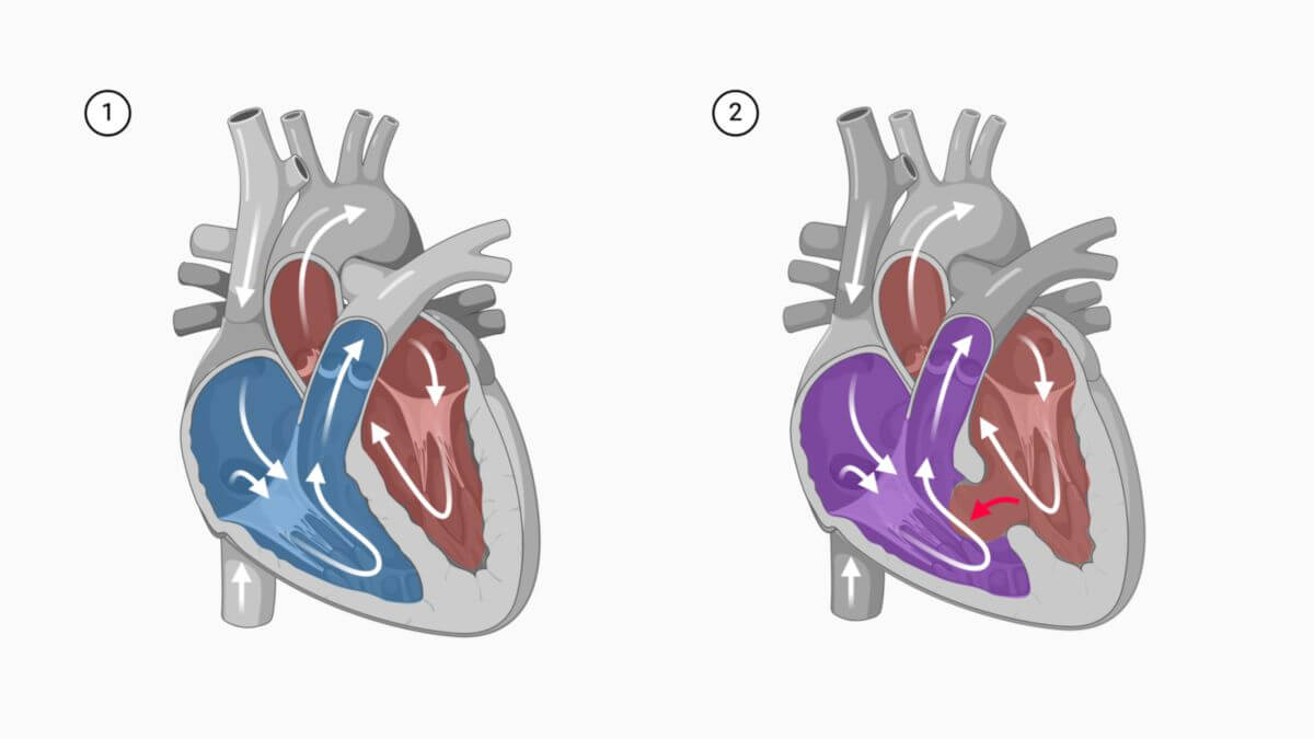 Ventrikelseptumdefekt