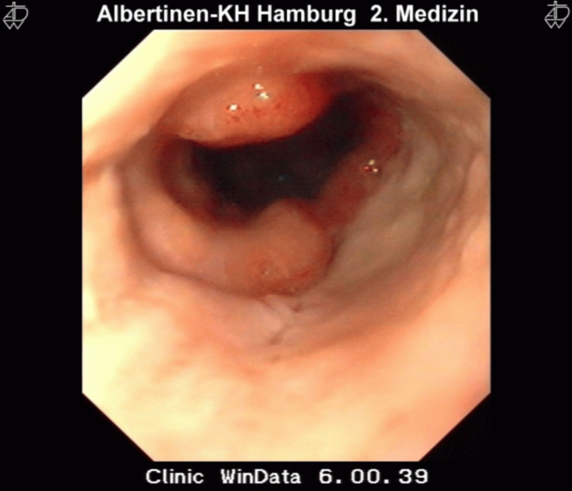 Stenosierende Ösophagitis