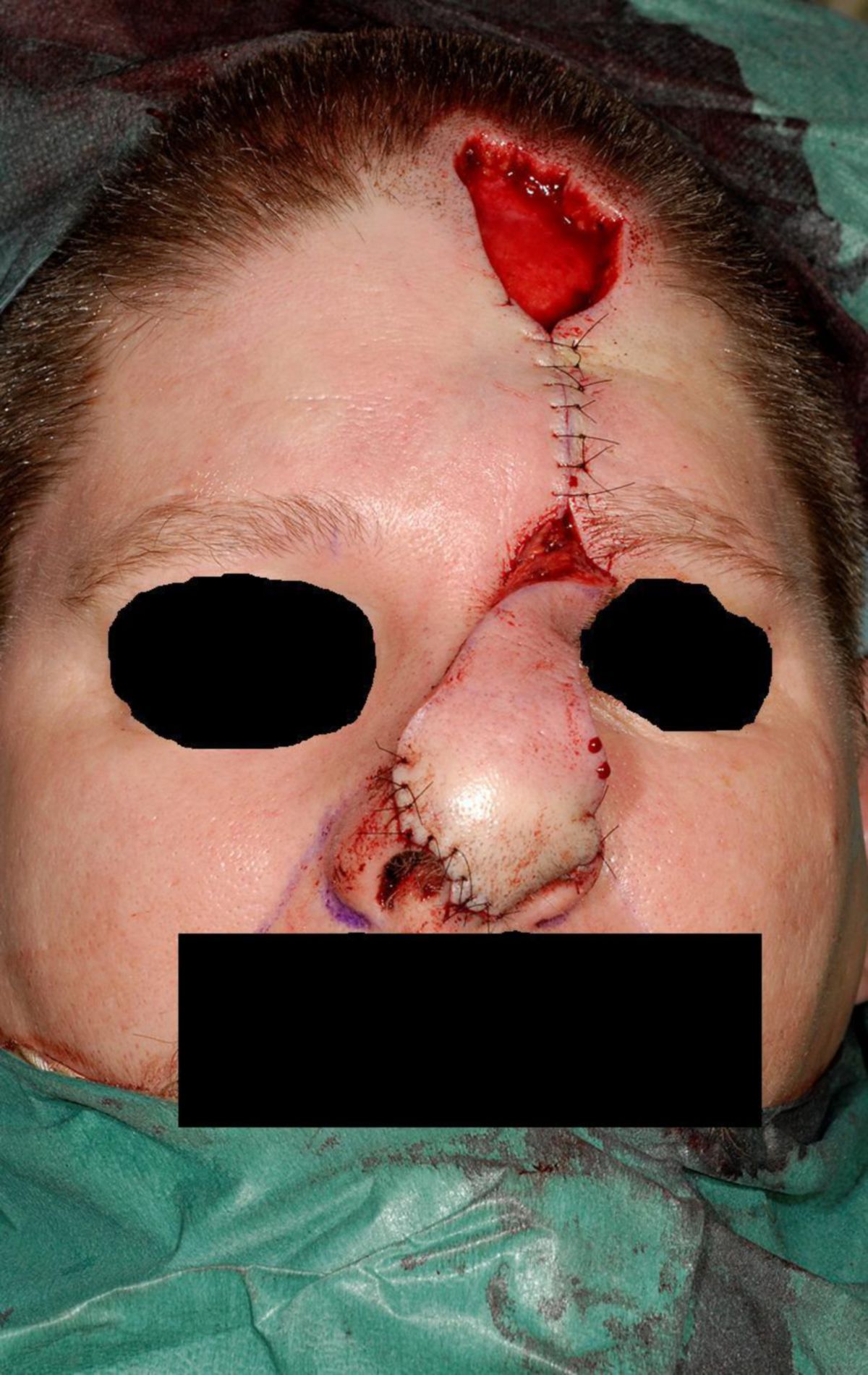 Nasenrekonstruktion mit Vollhauttransplantat aus Stirnlappen (4)