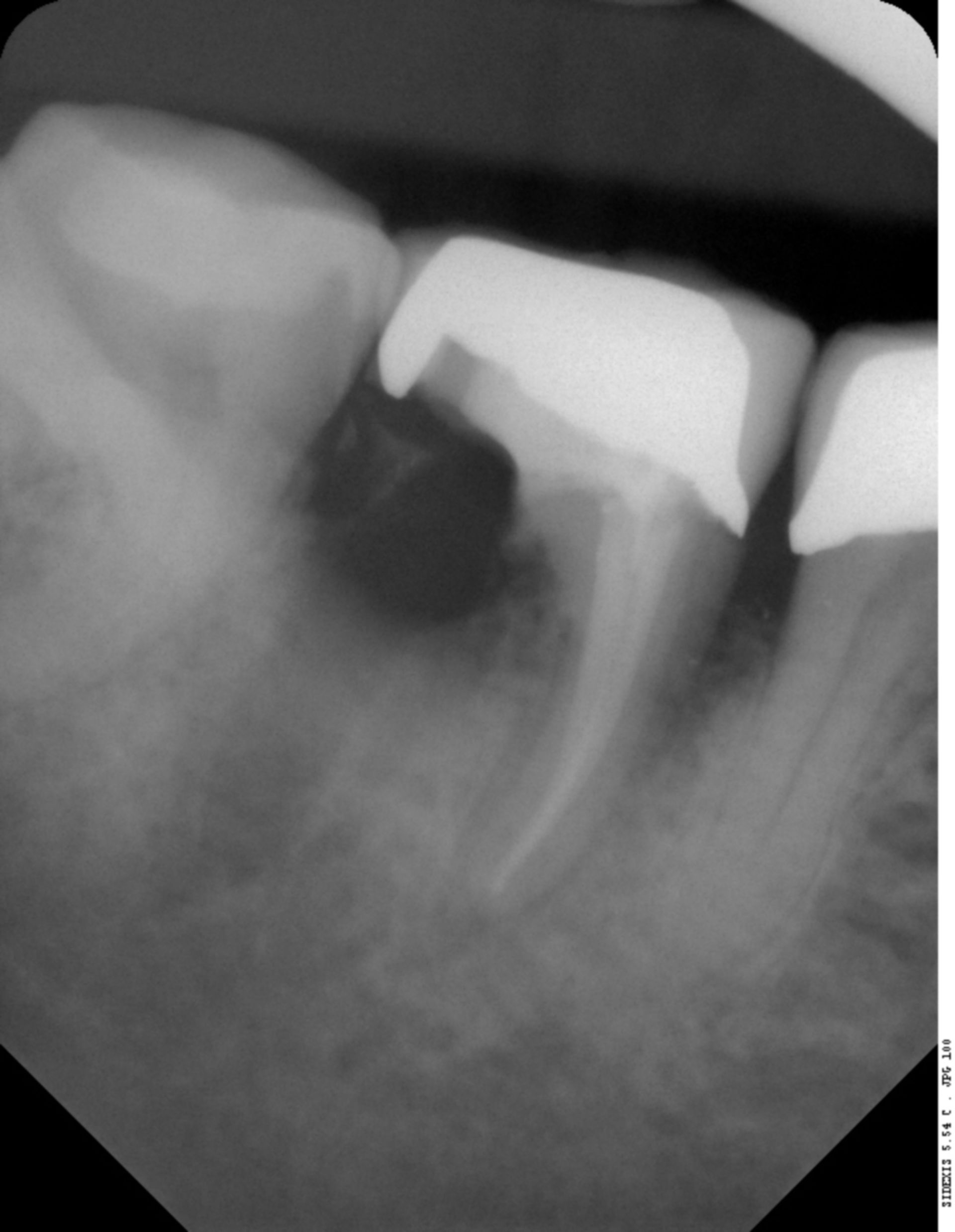 X-Ray: Tooth