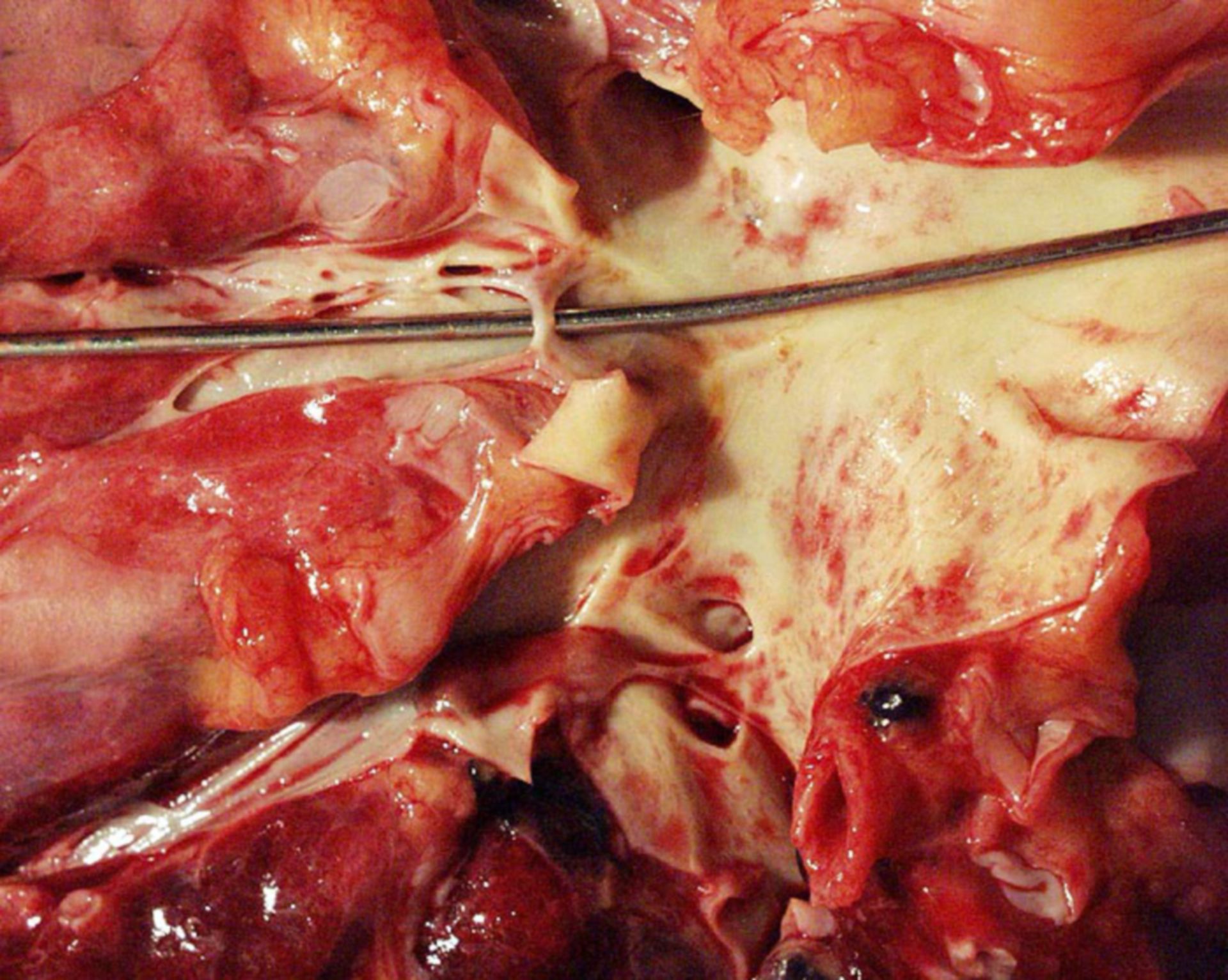 After pulmonary embolism